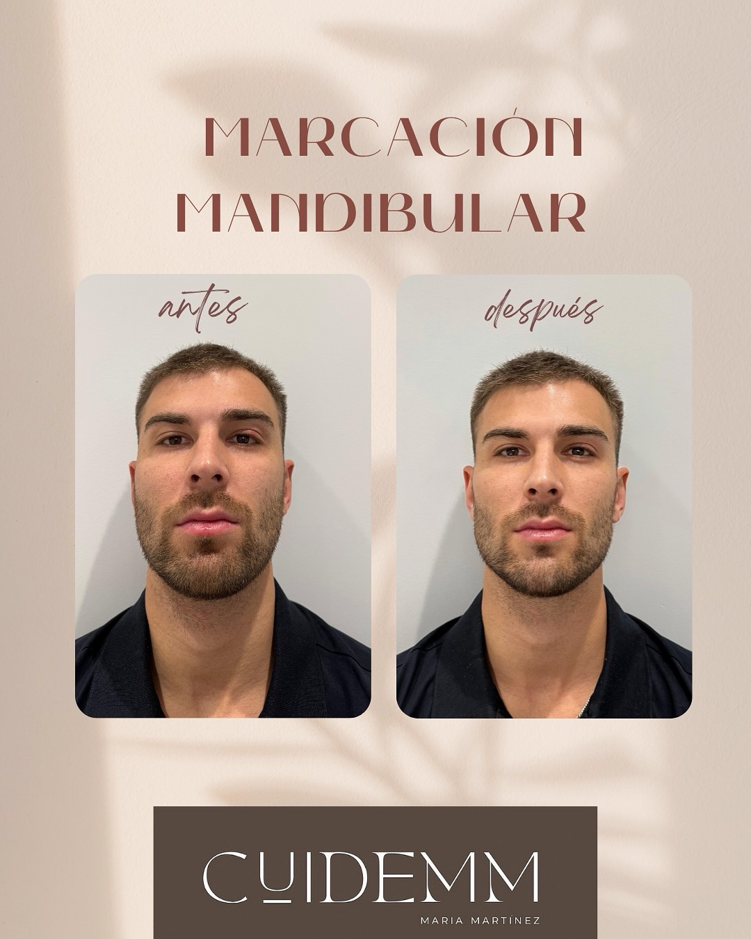 Definición, naturalidad y armonía.
En CUIDEMM, buscamos siempre resultados naturales y equilibrados.
En este caso, nuestro paciente quería una perfil mandibular más definido, resaltando su estructura y manteniendo su expresión masculina. 👨⚕️
El Dr. Martín trabajó con solo tres viales:
👉 Dos más densos en la zona mandibular
👉 Uno menos denso en el mentón
Además, se utilizó cánula, una técnica que permite un procedimiento más seguro, menos doloroso y con un mejor resultado estético, reduciendo el riesgo de hematomas o molestias. 💙
📸 Desliza para ver el antes y después.
Pequeños cambios, grandes resultados.
👉 Pide tu cita o consúltanos por WhatsApp para descubrir cómo realzar tu mejor versión.
#CUIDEMM #DrMartín #MedicinaEstética #MarcaciónMandibular #ArmonizaciónFacial #Fillmed #ÁcidoHialurónico #ResultadosNaturales #BellezaMasculina #CuidarseEsQuererse #CuidemmLaAlcudia 💙