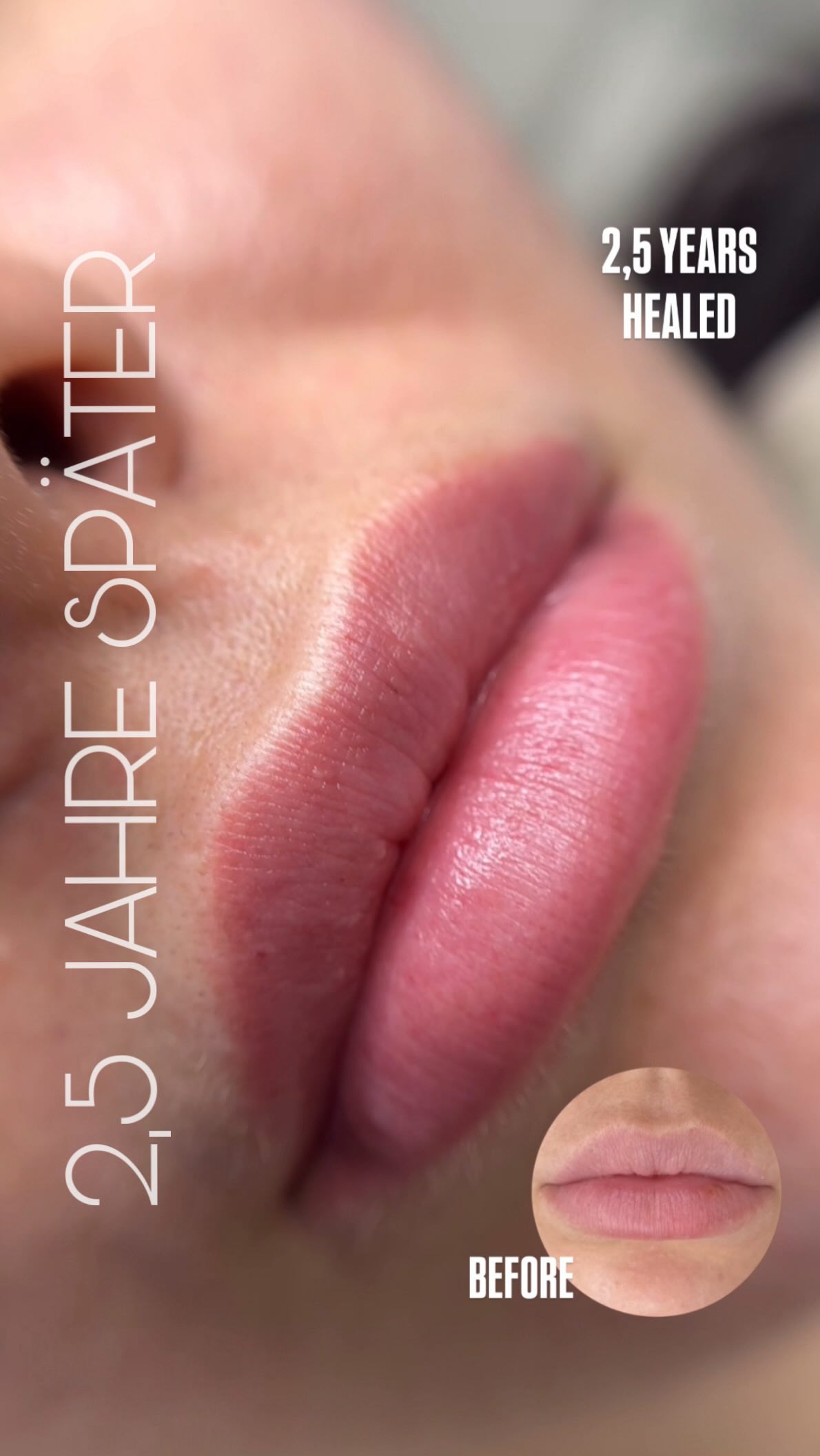 2,5 Jahre alt – und noch immer wunderschön
So sieht eine hochwertige Lippenpigmentierung aus: natürlich, frisch und einfach besser als vorher.
Klare Kontur, frische Farbe und Ausstrahlung.
Und das beste daran, es verschmiert nie🤩
LIPPENPIGMENTIERUNG
PERMANENT MAKE UP LIPS
AQUARELL LIPS
SWISSCOLOR