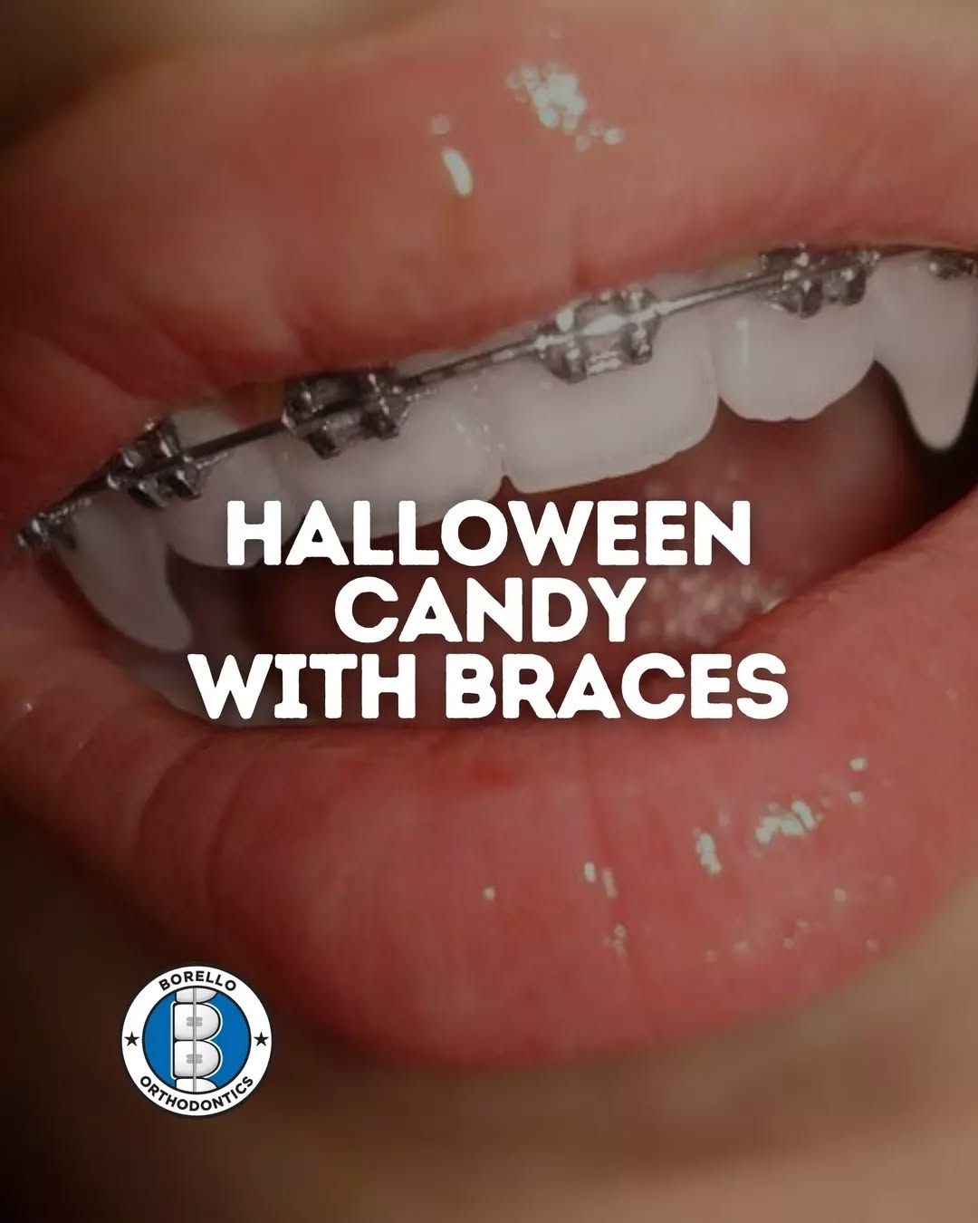 Halloween candy season is here, and that means extra sugar on your teeth and braces. 🍭🦷 Keeping up with your brushing and flossing is the best way to protect your smile from cavities, and being mindful of which candies you’re eating prevents broken brackets! 😁
Swipe through for Borello Ortho-approved tips on how to enjoy your Halloween candy the right way! You’ll learn which treats are braces-friendly, how to rinse away sugar, and when it’s best to brush.