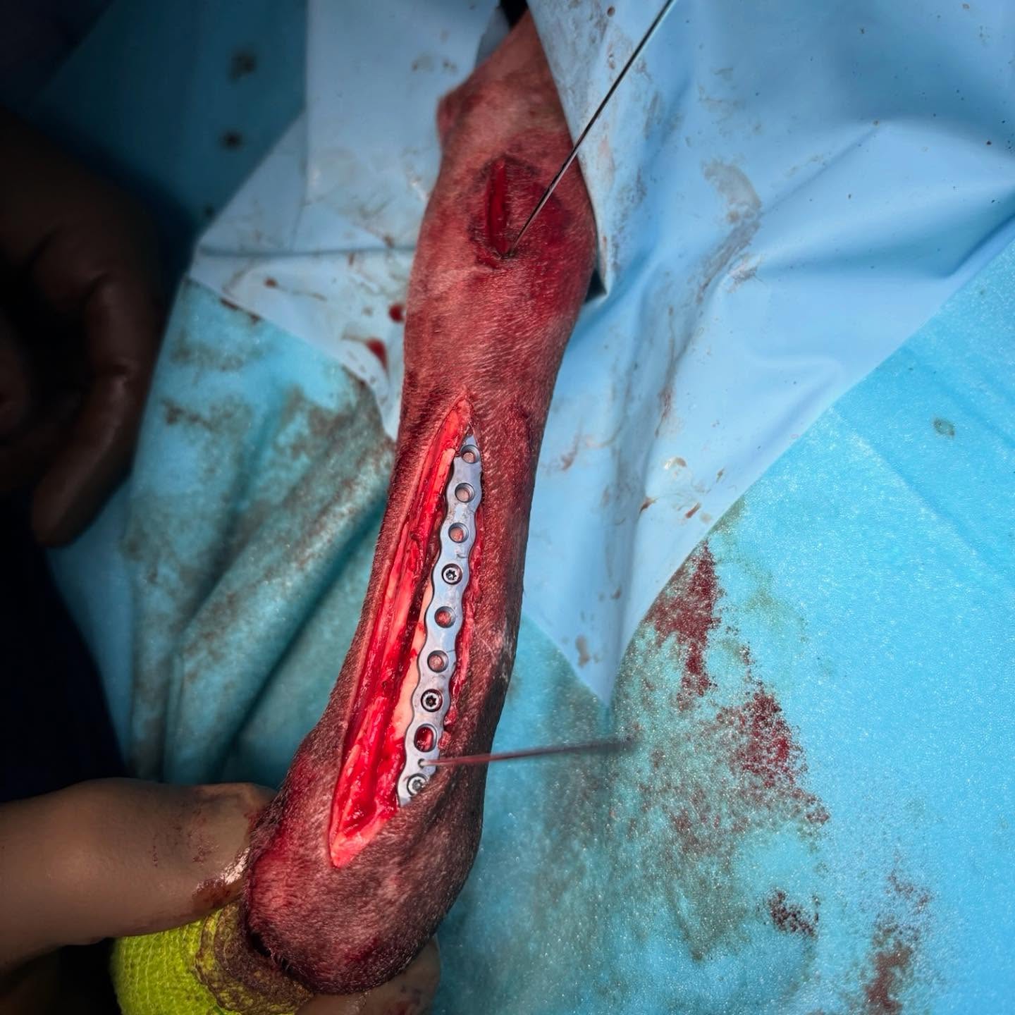 Minimally invasive, craniolateral approach to a distal short-oblique radius ulna fracture in a 7-year-old Male, neutered Italian Greyhound.
———
Based on the cadaveric, paired-comparison study by Lin et al, (VCOT 2025) a craniolateral approach provides significantly more bone exposure (especially proximally), which is advantageous for minimally invasive approaches to the radius
Exposure was templated with latex and quantified; proximal width was sampled at predefined intervals. A standard craniolateral (CLA) approach exposed a larger surface area of radius than a craniomedial (CMA) approach (~19.4 ± 4.7 vs 13.8 ± 3.2 cm²; p=0.01). Length of exposure did not differ (12.9 ± 1.4 vs 11.4 ± 2.8 cm; p=0.08). Proximal width was greater for CLA at one measured level (P2; p=0.016)