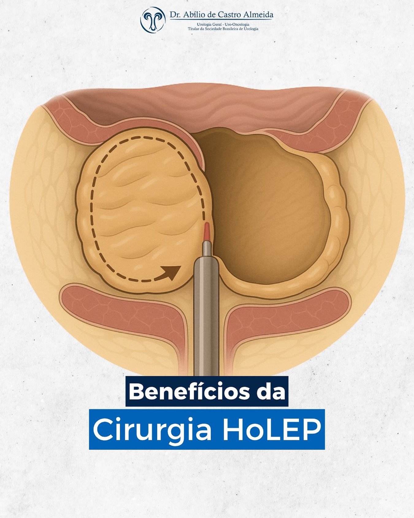 A cirurgia HoLEP (Enucleação Prostática com Laser de Hólmio) é uma técnica moderna e minimamente invasiva utilizada no tratamento do aumento benigno da próstata (Hiperplasia Prostática Benigna).
Ao contrário das cirurgias tradicionais, a HoLEP não exige cortes externos e permite uma recuperação mais rápida e confortável.
✨ Principais benefícios da HoLEP:
• ✅ Menor sangramento durante o procedimento
• 🏥 Alta hospitalar precoce
• ⚡ Alívio rápido dos sintomas urinários
• 💧 Melhora significativa no fluxo urinário
• 🔁 Resultados duradouros e baixa taxa de complicações
📌 Essa técnica é especialmente indicada para pacientes com próstatas aumentadas que buscam um tratamento eficaz e com rápida recuperação.
#HoLEP #Urologia #SaúdeDoHomem #Próstata #HiperplasiaProstática