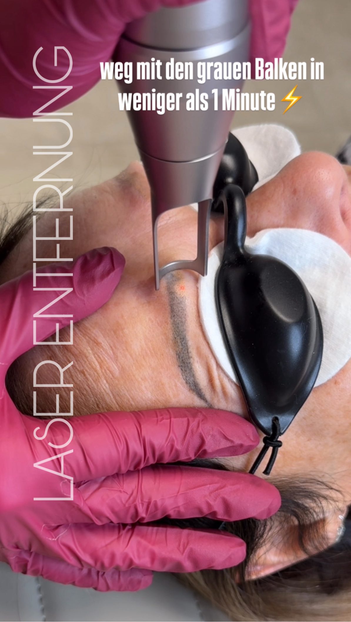 Ciao graue Balken 👋 Wir machen Platz für neue, schöne Powder Brows 😍
Wusstest du, dass die Haut nur eine begrenzte Kapazität hat, um Pigmente aufzunehmen?
Jedes weitere Nachstechen wäre hier leider für die Katz 🐈 – nach ein paar Wochen sehen die Brauen meist wieder genauso (oder sogar schlimmer) aus.
In solchen Fällen hilft wirklich nur eine Entfernung – alles andere ist nur Geld- und Zeitverschwendung.
Komm gern vorbei, ich berate dich ehrlich und professionell 🤍