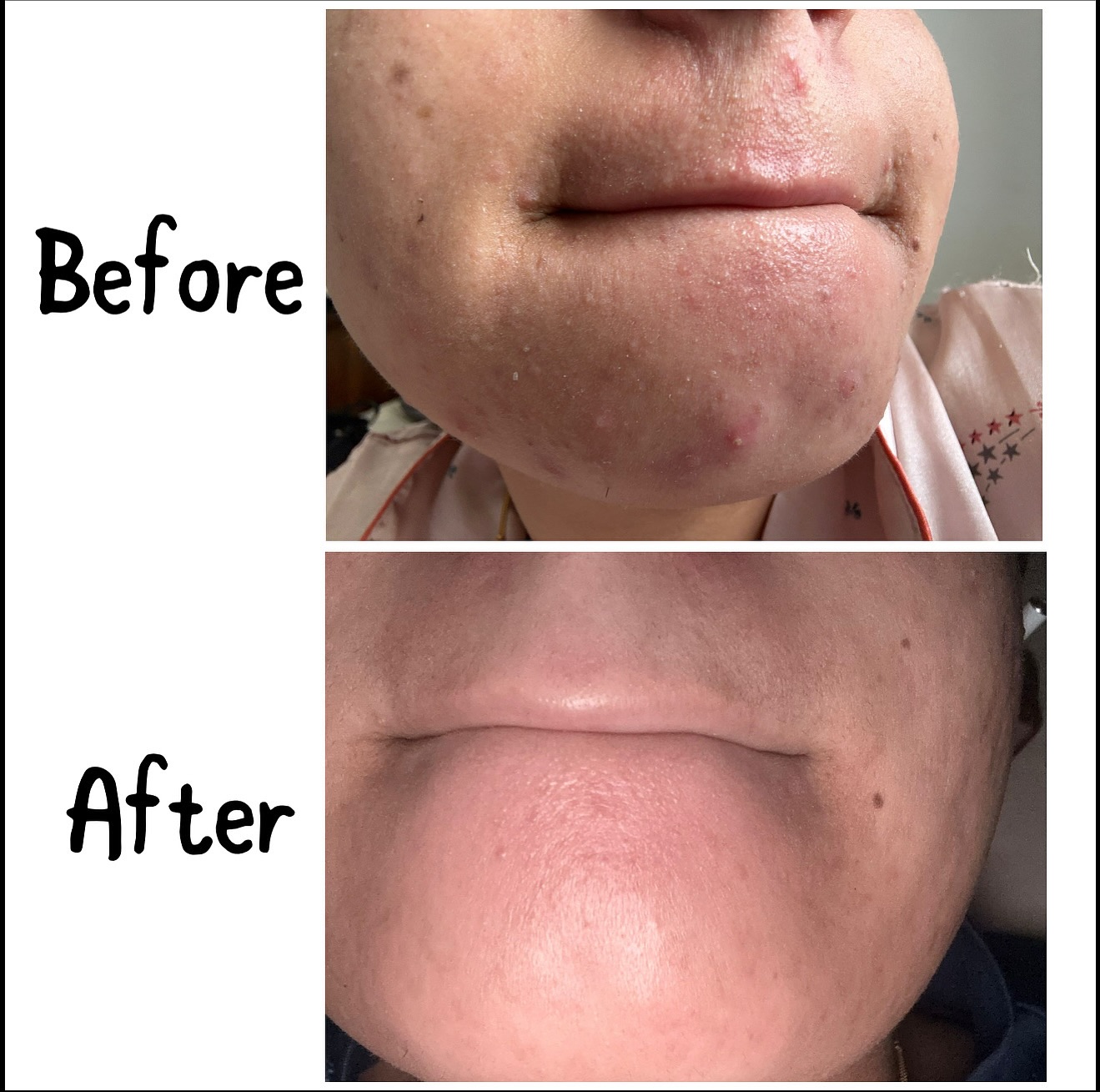 Healthy, glowing skin doesn’t happen overnight — but results like these make it worth it.
#surrey #glow #health #healthylifestyle #glowing #surrey #delta #canada #love #healthandwellness #glymedplus #chemicalpeel #microneedling #love #lovemyskin #skincareroutine #skintreatment #skintightening #treandingreels #reels