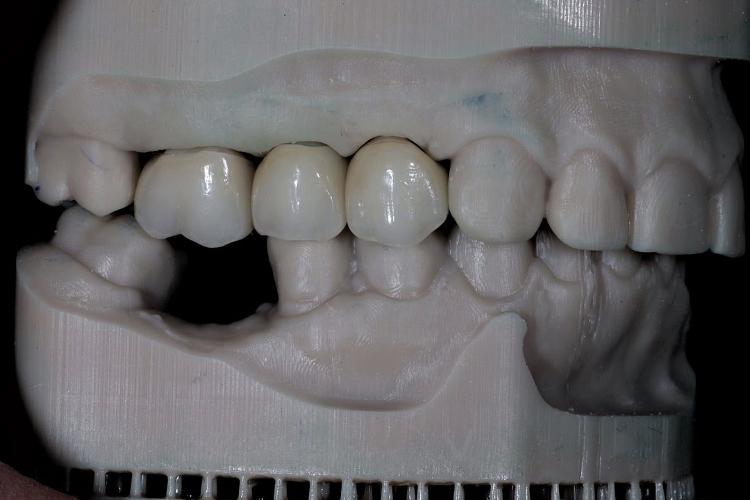 6 Lisi Posterior Crowns