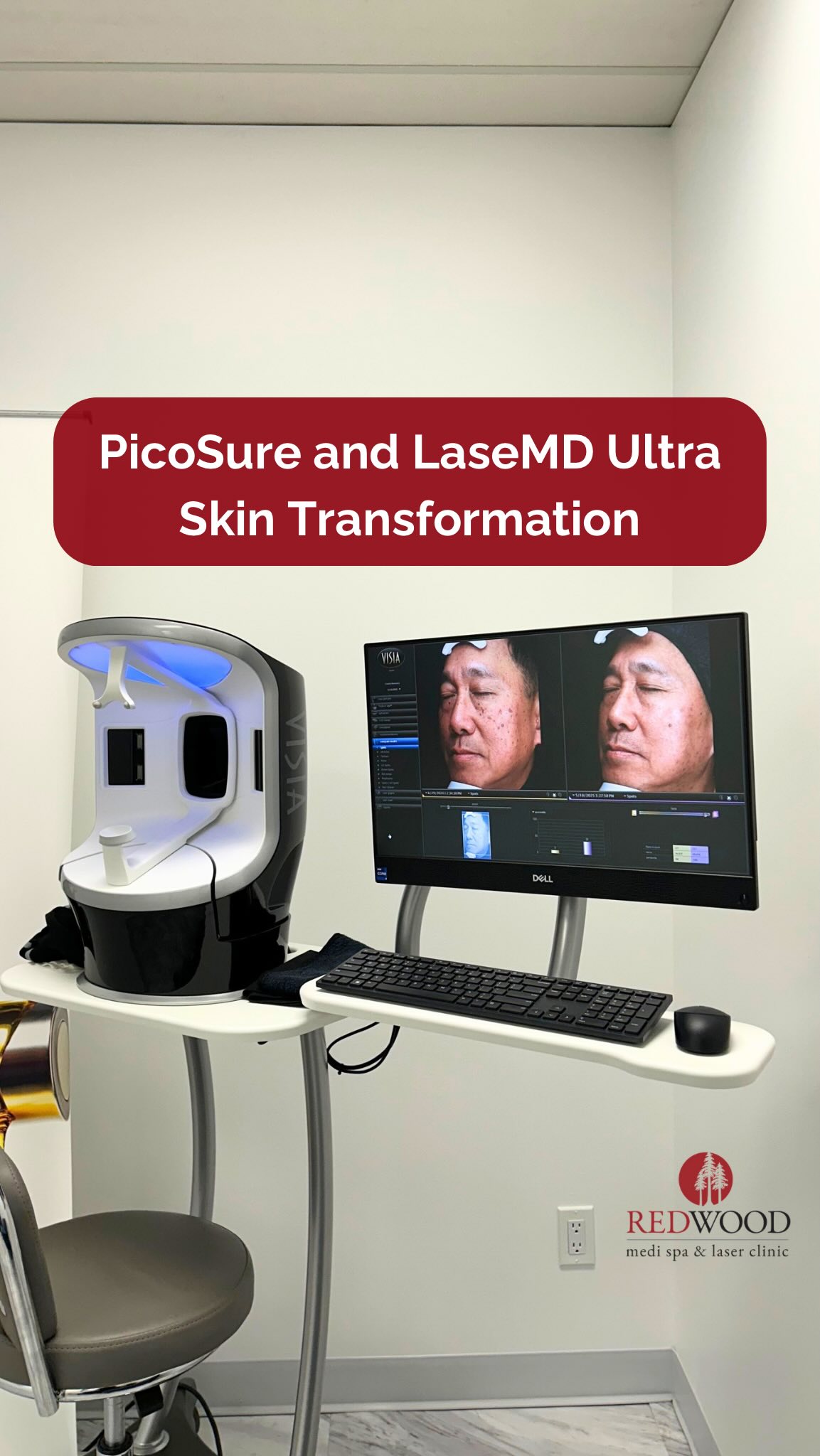 ✨ This incredible before-and-after shows what’s possible when PicoSure and LaseMD Ultra work together, and it’s all captured with our VISIA Skin Analysis system for true and measurable results!
PicoSure targets stubborn pigment and sun damage, while LaseMD Ultra resurfaces and renews the skin from within, leaving it brighter, smoother, and more even-toned. 💆♀️
Your skin deserves more than a quick fix. It deserves technology that truly transforms. ☺️
📍 4141 Yonge St, Unit 304, Toronto, ON M2P 2A6
📞 (416) 481-2888
📩 info@redwoodmedispa.com
#redwoodmedispa #picosure #lasemdultra #skinrejuvenation #acnescars #hyperpigmentation #melasma #torontomedispa #glowingskin #skintransformation #beforeandafter #redwoodbeforeandafter #visiaanalysis #visiaskinanalysis