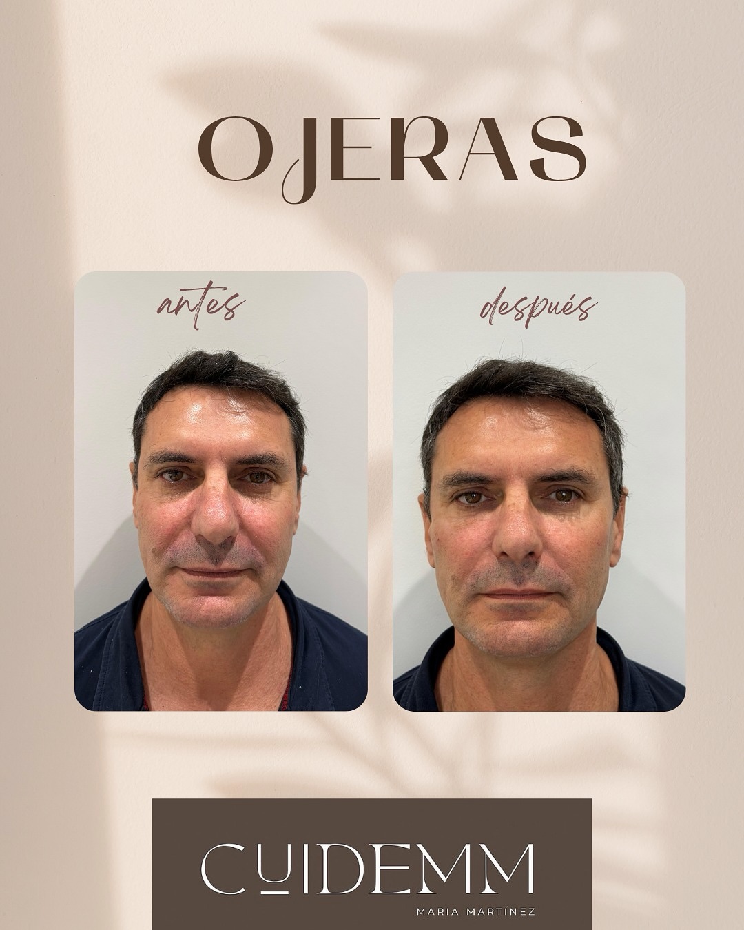 👁️✨ Miradas que reflejan descanso y luminosidad.
En CUIDEMM, trabajamos para devolverle a tu mirada su frescura natural.
Este tratamiento, realizado por el Dr. Martín, está diseñado para reducir el aspecto de cansancio, suavizar ojeras y aportar luz a la zona del contorno de ojos. 💉💙
Utilizamos Art Filler Eyes, el nuevo producto de FILLMED, creado específicamente para tratar la delicada área periocular con resultados naturales, seguros y duraderos.
💫 Un pequeño gesto que consigue una gran diferencia: una mirada más descansada, vital y rejuvenecida.
👉 Pide tu cita o consúltanos por WhatsApp para descubrir si este tratamiento es para ti.
📍 CUIDEMM – La Alcudia
#CUIDEMM #DrMartín #Fillmed #ArtFillerEyes #Ojeras #MiradaDescansada #RejuvenecimientoFacial #MedicinaEstética #ResultadosNaturales #BellezaReal #CuidarseEsQuererse #CuidemmLaAlcudia 💙