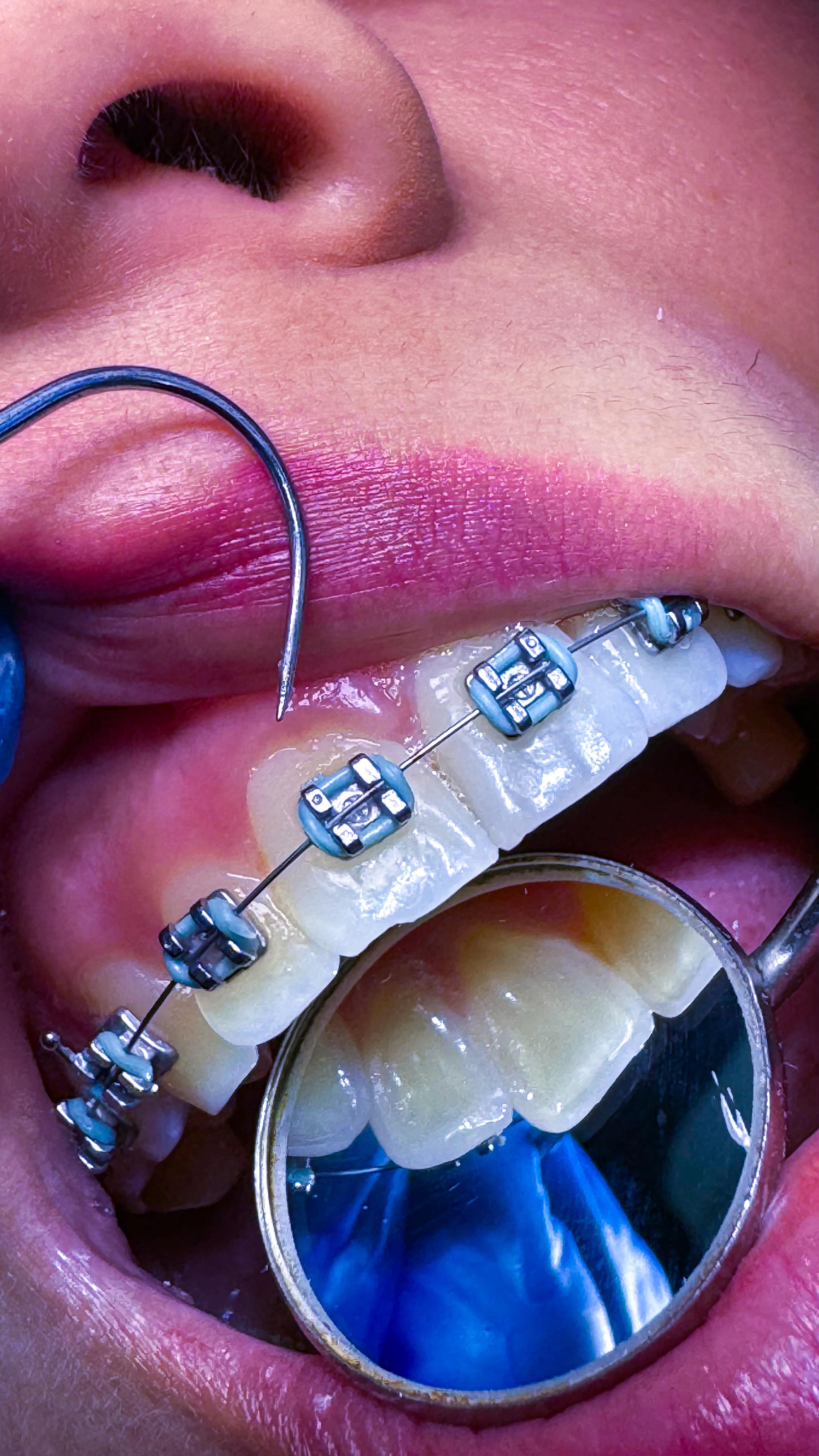 🦷¿Tienes un diente que se ve gris?
😅No siempre se trata de una simple mancha; puede deberse a diferentes causas, algunas estéticas y otras relacionadas con tu salud oral. Entre las más comunes se encuentran:
✔️Golpes o traumas dentales
✔️Necrosis pulpar (muerte del nervio)
✔️Tratamientos previos de endodoncia
✔️Uso de ciertos medicamentos durante la infancia
✔️Envejecimiento natural del diente
✔️Caries profundas
✔️Defectos en el esmalte o hipomineralización
✔️Exceso de flúor (fluorosis severa)
✔️Malos hábitos o higiene deficientes
👉Recuerda: un diente gris no se aclara por sí solo.
👩⚕️🦷Con un diagnóstico odontológico adecuado en NAO Clínica de Sonrisas podemos identificar la causa y ofrecerte el tratamiento ideal para devolverle el color y la vitalidad a tu sonrisa.✨
📲Escríbenos y agenda tu valoración con nosotros.
#naoclinicadesonrisas #clinicanao #sonrieconconfianza #odontologoscali #odontologospalmira #odontolovers #odontologia