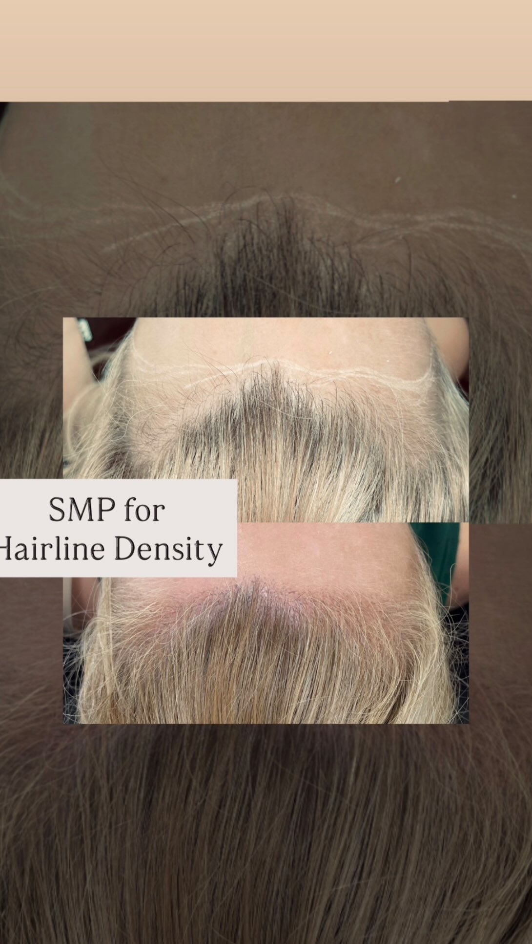 👩🦰 Female SMP Hairline Density.
Subtle, Feminine, Transformative 💫
Because confidence looks best when it’s effortless, and your hairline should too.
Our Female SMP Hairline Density treatment restores the look of natural fullness where it’s thinning, blending artistry and precision for a soft, feminine finish.
This non-invasive service at BLADED Inc enhances your natural beauty and redefines what confidence feels like.
Perfect for women in Zionsville, Carmel, and Westfield seeking hairline restoration without the commitment of transplants or maintenance of extensions.
✨ DM “HAIRLINE” or visit the link in bio to schedule your private SMP consult.
#FemaleSMP #HairlineDensity #WomenHairRestoration #BladedInc #ZionsvilleBeauty #CarmelIndiana #zionsville #zionsvillemoms #carmelmoms #westfieldmoms #LuxuryHairRestoration #ConfidenceStartsHere #scalpmicropigmentation #smp #smpzionsville