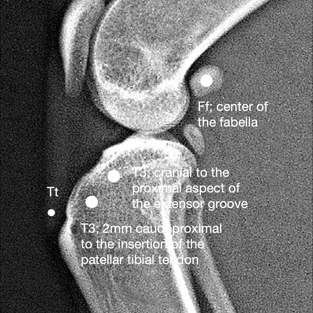 Feline-specific data on lateral suture anchor locations are scarce; extracapsular techniques are favored but prior “isometry” mapping was largely canine. This work provides a feline map and discusses where its findings align or diverge from canine studies (e.g., Roe et al.; Hulse et al.).
———
Radiographic cadaveric study (7 cats, 14 stifles). Radiopaque beads marked candidate femoral/fabellar and tibial points; distances were measured at 45°, 90°, 130°, and 166°. Variation of distance was summarized as VOD% relative to 45°, and group comparisons used ANOVA with Bonferroni. Inter-rater agreement was high (R≈0.976).
The smallest length change across ROM was between the fabella center and a tibial point 4 mm proximal to the patellar tendon insertion (Ff–Tt). Reported VOD% for Ff–Tt was ~1.7% at 90° and −0.2% at 166°, significantly lower than all other pairs tested. However, the authors note the feline fabella and femorofabellar ligament are small and relatively mobile; looping here can damage perifabellar soft tissues and may not provide a firm anchor clinically, even though it is the most isometric radiographically. The next lowest variations were Ff–T2 and Ff–T3 (both <7%).
Landmarks identified in the lateral stifle (arrow): the center of the fabella (Ff) and one 4mm proximal to the insertion of the patellar ligament adjacent to the tibial cortex (Tt)
(arrow).
Femoral points:
F1—caudal aspect of the lateral femoral condyle and proximal to the lateral fabella;
F2—caudal aspect of the lateral femoral condyle and distal to the lateral fabella;
Tibial points:
T1—caudal to the proximal aspect of the extensor groove;
T2—cranial to the proximal aspect of the extensor groove;
T3—2mm caudoproximal to the insertion of the patellar tibial tendon, and
T4—3mm caudal to the insertion of the patellar tibial tendon
