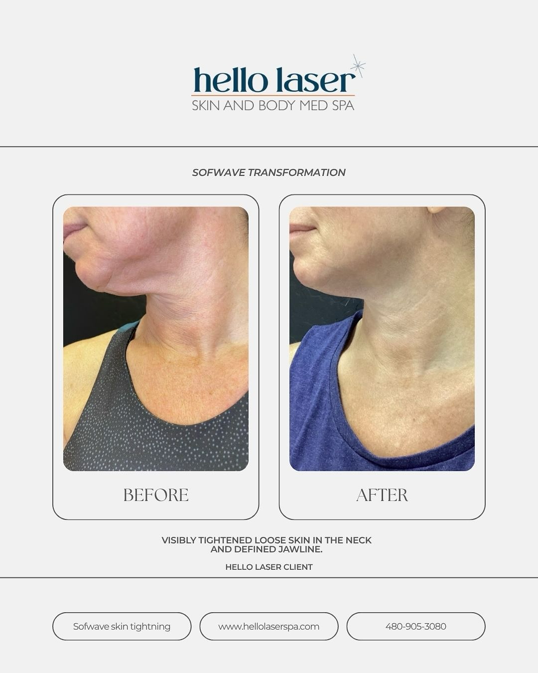 Who Needs a Filter When You Have Sofwave?🤭
No needles, no downtime just tighter, smoother, younger-looking skin thanks to Sofwave® Skin Tightening!
This FDA-cleared treatment uses next-generation ultrasound waves to stimulate collagen and elastin deep within the skin tightening, lifting, and contouring areas like the neck, jawline, and face.
🕒 When will you see results?
Some notice improvement within weeks, but the real magic happens around 3 months as your collagen rebuilds from within.
Ready for your glow-up moment? 💫
Book your complimentary consultation today and see what Sofwave can do for you!
📍 Only in Scottsdale
📞 480-905-3080
🌐 hellolaserspa.com
#Sofwave #HelloLaser #SkinTightening