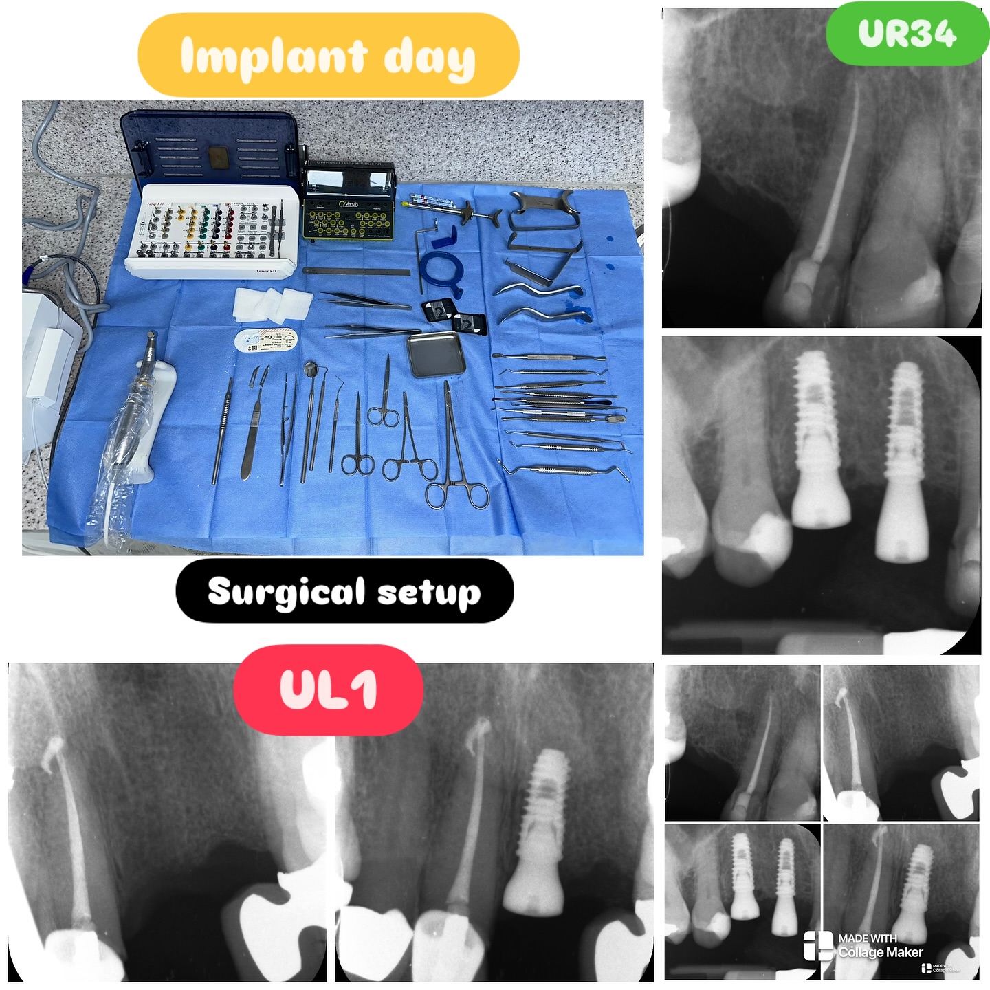 #nhs #treat #treatment #endowarrior #endodontia #rootcanaltreatment #rootcanaltherapy #endobelly #waves #waveonegold #saveteeth #endospecialist #treatyourself #simplicity #dentaltreatment #compositebonding #dentistry #endodontics #dentalimplants #dentalimplant #dentalimplantsurgery #dentalimplantology #dentalimplanttreatment #dentalimplantexperts