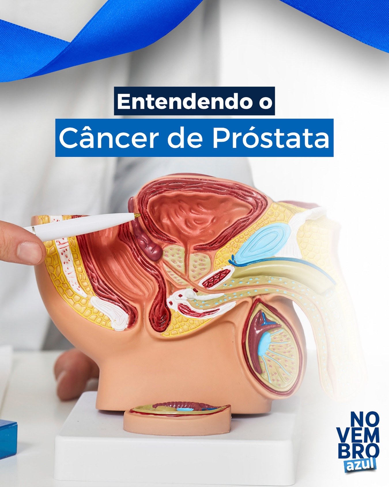 O câncer de próstata é o segundo tipo mais comum entre os homens no Brasil, e a detecção precoce faz toda a diferença — as chances de cura ultrapassam 90% quando o diagnóstico é feito nas fases iniciais. 👨⚕️
📍 Fatores de risco: idade acima de 50 anos, histórico familiar da doença, obesidade e hábitos de vida pouco saudáveis.
⚠️ Sintomas (quando aparecem):
– Dificuldade ou dor ao urinar
– Vontade de urinar com frequência, especialmente à noite
– Presença de sangue na urina ou no sêmen
– Dor óssea em casos mais avançados
🔍 Diagnóstico: realizado através do exame de toque retal e do PSA (Antígeno Prostático Específico) — exames simples, rápidos e fundamentais para o rastreamento.
💪 Tratamento: varia conforme o estágio da doença e pode incluir:
– Acompanhamento com vigilância ativa
– Radioterapia ou bloqueio hormonal
– Cirurgia para retirada da próstata — que pode ser feita por via robótica, oferecendo mais precisão, menor dor e recuperação mais rápida. 🤖
Cuidar da saúde é um ato de coragem e amor à vida.
Converse com seu urologista e incentive outros homens a fazerem o mesmo. 💙
#NovembroAzul #SaúdeDoHomem #CâncerDePróstata #Prevenção #Urologia #CirurgiaRobótica
