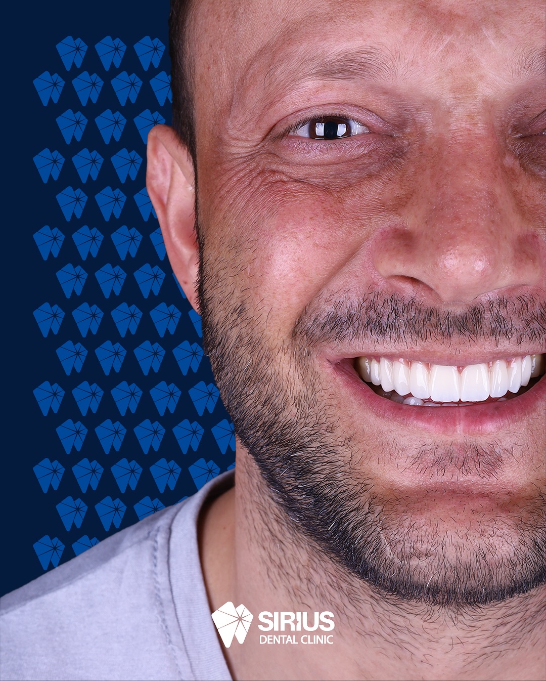 ✨Subtle refinements, outstanding results.
A naturally beautiful smile, perfected with zirconium.
📍Ilıca Mahallesi, 38.Sokak No:1B Manavgat/Antalya
📲 0553 756 0 756
💻 www.siriusdentalclinic.com
#siriusdental
#ZirconiumSmile
#SmileDesign
#NaturalAesthetics
#DentalTransformation
#RadiantSmile
#AestheticDentistry
#ConfidenceInYourSmile
#PerfectSmileJourney
#SmileMakeover
#DentalArtistry