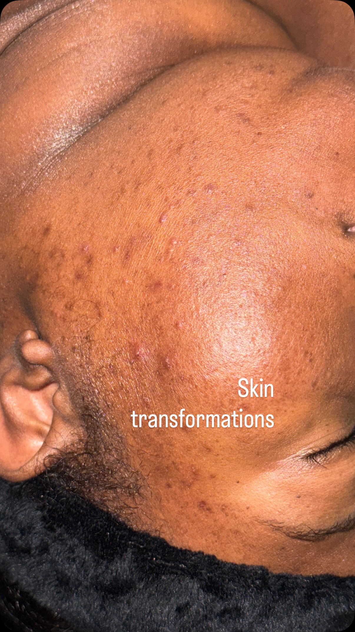 Guess what! New service ALERT! Do you want the power of an esthetician at home? We now offer custom blended skin care for at home use so you don’t have to wait for a facial to start seeing results. Visit kemskin.com to book a consultation You can start getting results in the comfort of your home #skin #skincare #athomeskincare #kemskin