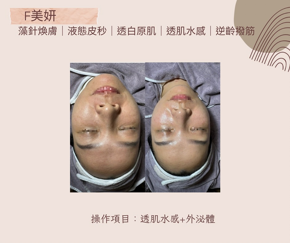 每次的膚況紀錄都可更了解每一次的進步。
謝謝這位客戶遠從遙遠的東台灣,來高雄護膚
做完白ㄧ皆,透一皆,亮一皆膚況更好了
都是正常發揮✌️
📌 預約流程:
1️⃣ 私訊LINE https://lin.ee/9sW3orj
點選主頁我要預約輸入資料直接點選適合的日期與時間
2️⃣ 確認後支付訂金完成預約
3️⃣ 預約前一天會訊息提醒您,請於約定時間準時前來,享受專業護理。
地點:高雄市左營區博愛三路(預約成功提供完整地址)
營業時間:10:00-19:30(採預約制)
#高雄做臉 #高雄做臉推薦 #高雄清粉刺 #高雄美容工作室 #液態皮秒 #痘痘 #內包粉刺 #粟粒腫處理 #肉芽