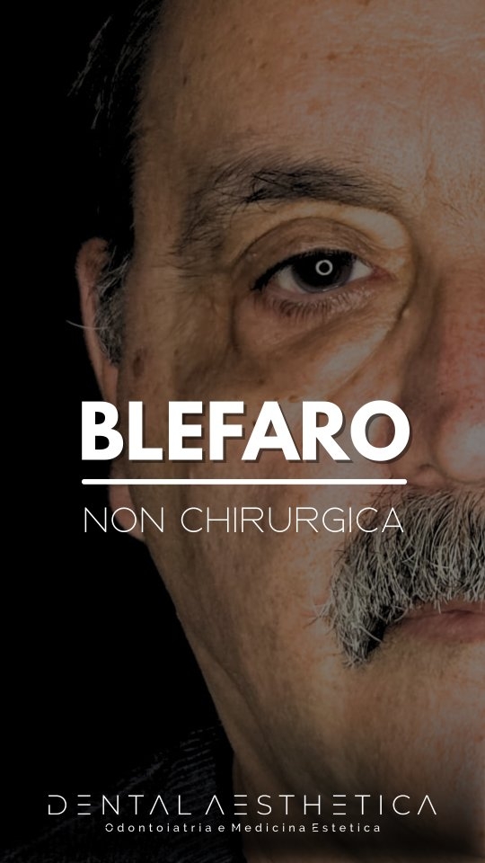 👁 Palpebre stanche ma non vuoi sottoporti a chirurgia?
La tecnologia laser può migliorare rugosità, texture e lassità perioculare. 👉🏻@almalasers_italia
✔️3 punti chiave:
☝🏻Sicurezza: protocolli medici certificati
✌🏻Recupero: rossore/edema per 2/5 giorni
👌🏻Percorso: risultati graduali in 3 sedute distanziate in media di 4/6 settimane
Vuoi saperne di più? Scrivici nei commenti o fissa una consulenza personalizzata.
#blefaro #medicinaestetica #pellegiovane #chirurgia
