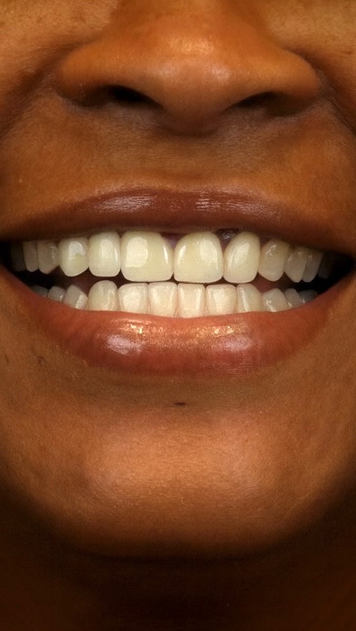 She came in hiding her smile and left with one that changed everything! 🙏🏼 Behind every transformation is a team: from our dedicated dental crew to our amazing dental lab. Together, we turned a vision into reality, proof that beautiful results are built on teamwork. #teamwork #smiletransformation #orlandodentist