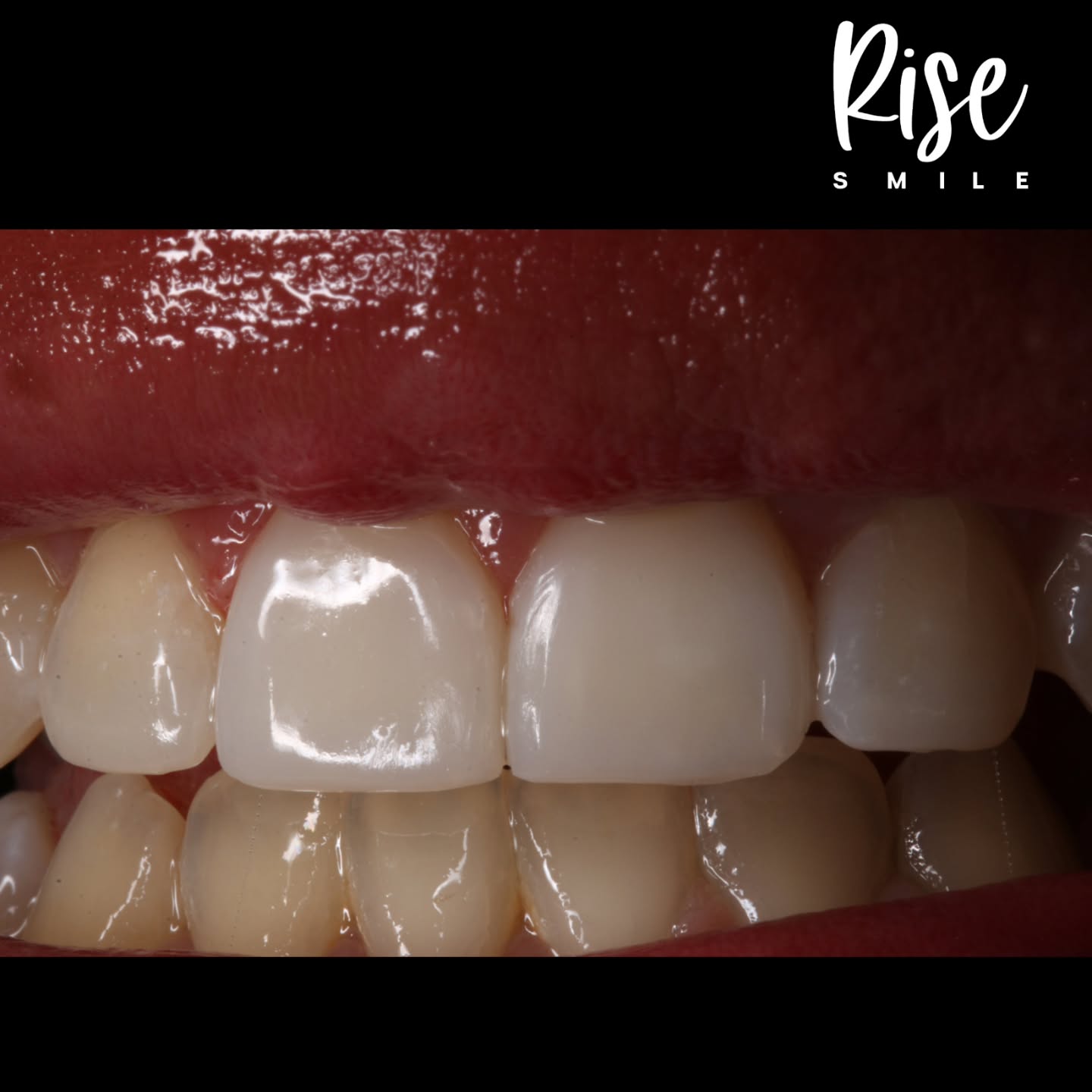 Carillas de Resina compuesta para finalizar tratamiento de prtodoncia en paciente con desgaste corrosivo. Procedimiento sin desgaste dental mejorando forma y estética de la sonrisa