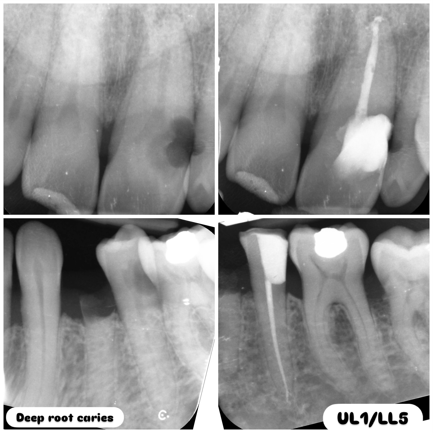 Extensively decayed teeth UL1 and LL5. Endo with core buildups. Both single visits. Composite cores. #nhs #treat #treatment #endodontia #rootcanaltreatment #rootcanaltherapy #endobelly #waves #waveonegold #saveteeth #endospecialist #treatyourself #simplicity #dentaltreatment #compositebonding #dentistry #endodontics #dentaltreatment #difficultendo #dentistrylife #dentistrylove #dentallife #oralhealth #veneers #dentalhygiene #healthysmile #dentalhealth #dentures #dentallab #dentalschool #dentalassistant #endodontics