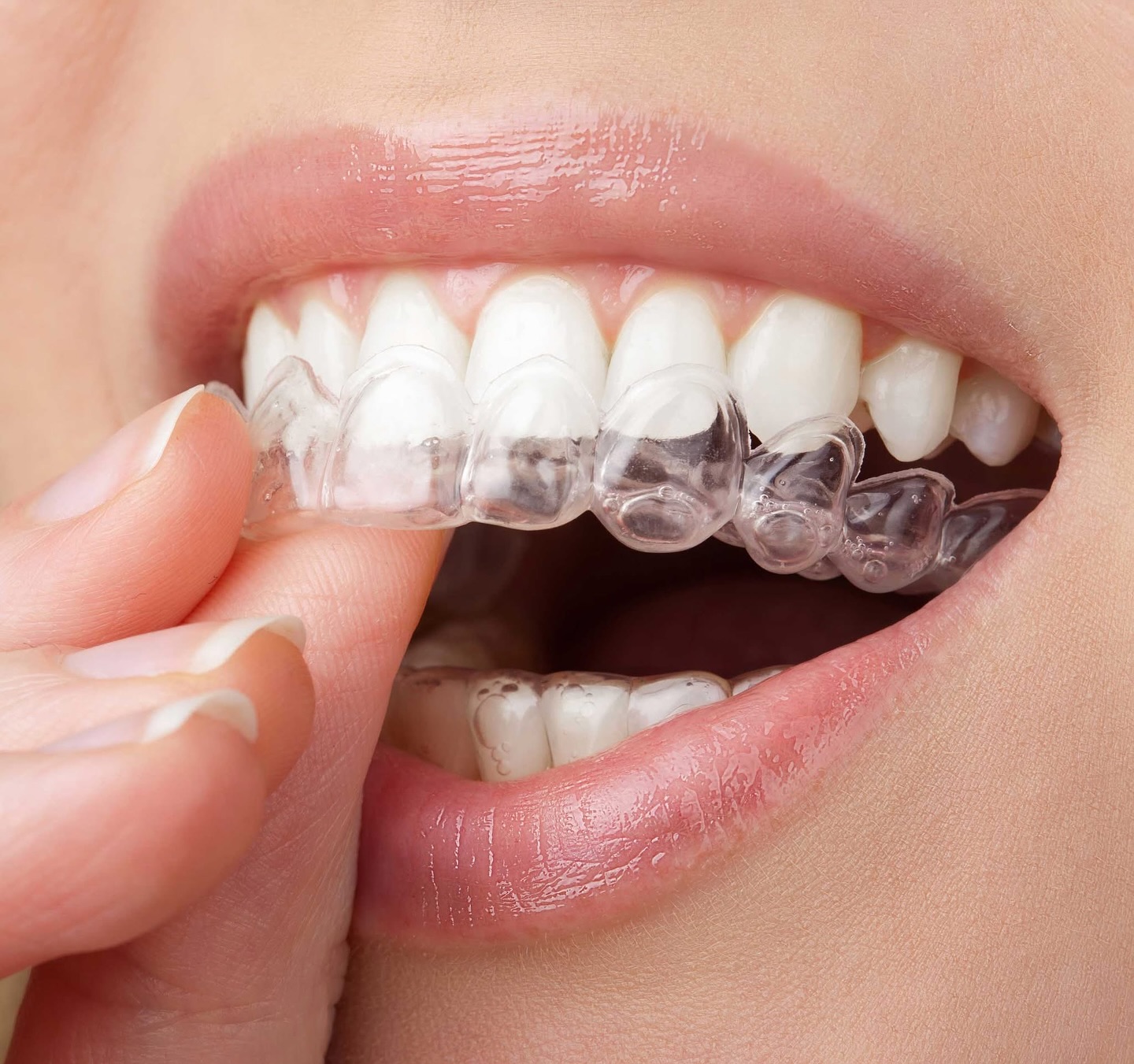 🦷5 Essential Care Tips for Your Retainers and Mouthguards! Proper maintenance is key to ensuring your orthodontic appliances last longer and keep your mouth healthy. Read our latest post for practical tips! Link in bio #Orthodontics #DentalHealth #Mouthguards
