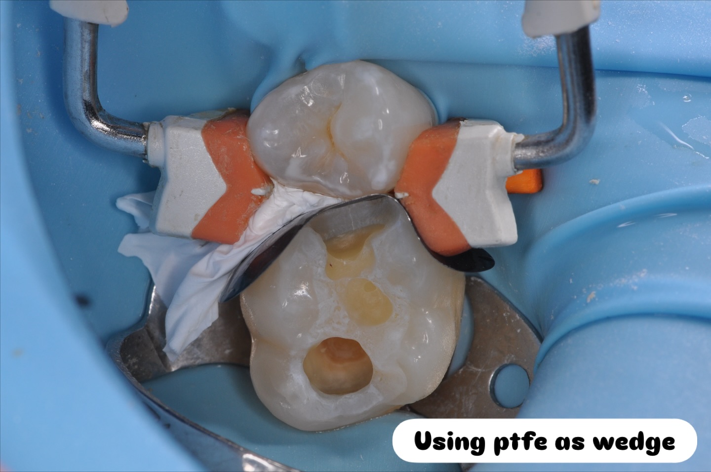 Using ptfe as wedge for those awkward morphologies where matrix does not approximate well #dentalfillings #compositefilling #compositefillings #savingteeth #whitefillings #sectionalmatrix
