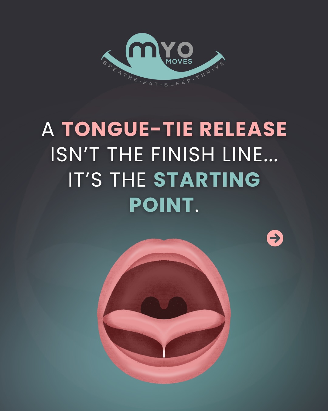 A tongue-tie release isn’t the finish line, it’s just the first step toward better function.
A tongue-tie restricts movement, but simply releasing the tie won’t automatically fix the problem. Here’s why:
🧠 A release gives you mobility
💪 But myofunctional therapy teaches the tongue how to rest, breathe, and swallow properly
Without retraining:
• The tongue can fall back into dysfunctional patterns 😕
• Issues like mouth breathing, low tongue posture & poor swallowing often remain 💤
• There’s a higher risk of re-attachment or scar tissue 🔁
Think of it like joining a gym. The membership doesn’t build the muscle, the training does! 🏋️♀️
Function + Frenectomy = Long-Term Success ✅
If you’re considering a tongue-tie release for you or your child, make sure therapy is part of the plan. Comment “TONGUETIE” below for more info & my resources sent straight to your DMs. 📩