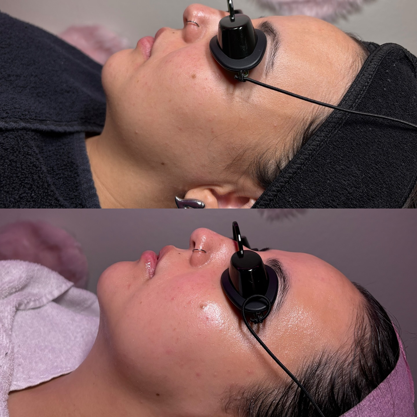 Results don’t happen overnight, they happen through consistency! 🤍
This baddie has been a monthly member for 5+ months, and we’ve worked intentionally on restoring her skin barrier, reducing congestion, rebuilding hydration, and facial sculpting!
Her glow didn’t come from a one-time facial or method, it came from trusting the process! 😌🤍
Healthy skin takes time to adjust, rebalance, and reveal its real glow!
If you’re ready to commit to long-term skin health, this is your sign to start your monthly facial journey with me! 🤍
#LicensedEsthetician #AcneSpecialist #BarrierRepair #GlowingSkinJourney #SkinTransformation #FacialResults #phoenixesthetician
