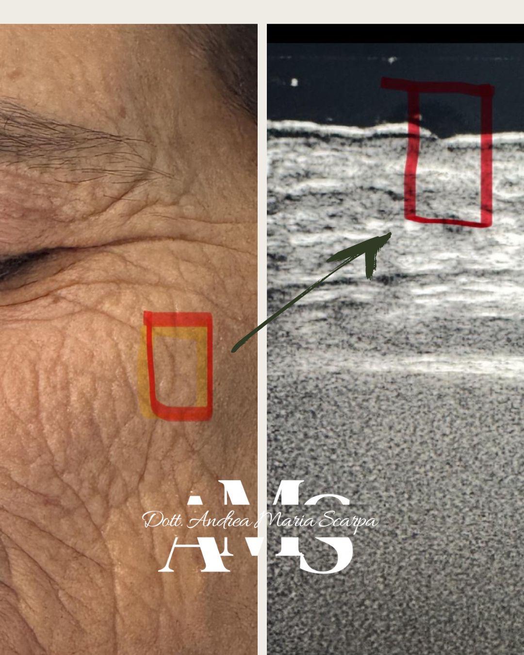 Oggi il dott. Scarpa ci offre un interessante spunto sulla sua visione di medicina di precisione applicata alla dermatologia estetica.
Grazie alla sonda L24 di Basel, con tecnologia very high frequency a 24 MHz, è possibile analizzare in modo estremamente dettagliato la cute perioculare, valutando lo spessore e le caratteristiche dei diversi strati cutanei.
Questo approccio consente di pianificare in maniera personalizzata il trattamento più idoneo — che si tratti di un filler o, come in questo caso, di un laser resurfacing — massimizzando efficacia e sicurezza.