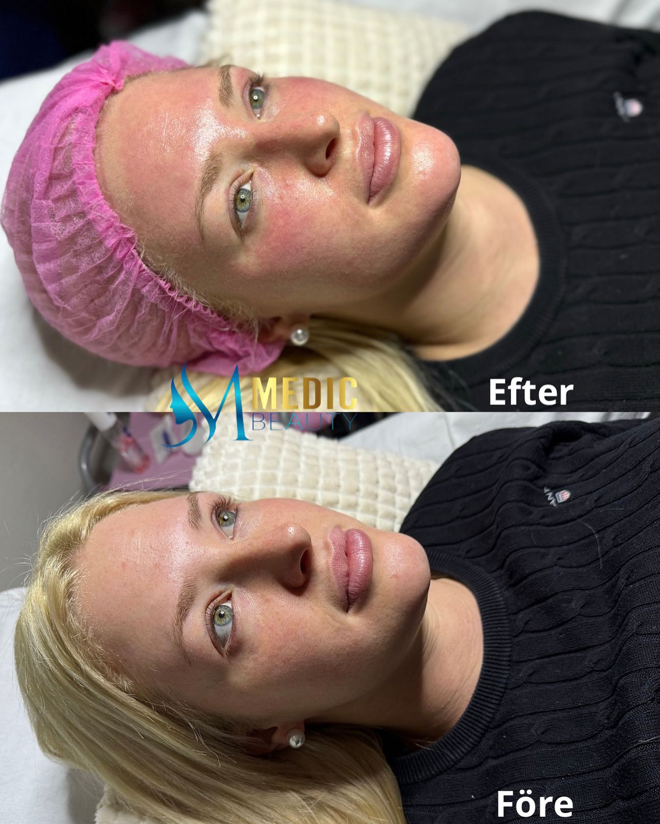 Microneedling+BB glow för maximal effekt av fukt, vitaminer och glow nu under denna mörkare och kallare tid✨😍
#boråsstad #glow #skönhetsklinik