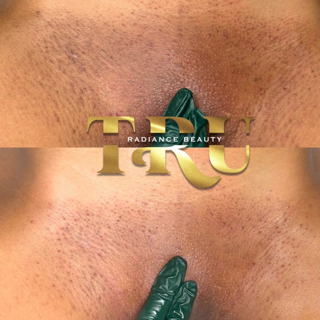 Confidence begins with self-care!
This beauty saw visible results after just ONE intimate bleaching session 🥰
Our Intimate Bleaching treatments are specially formulated for all intimate and sensitive areas — gentle, non-irritating, safe, and effective for every skin type
Each session includes your wax for smoother, more even results. For the best peel effect and deeper pigment correction, treatments are recommended every 4–6 weeks.
💫 Plus, every client receives an Aftercare Kit to maintain that glow between sessions!
#TruRadianceBeauty #IntimateBleaching #SkinCareGoals #CincinnatiEsthetican #BrazilianWax