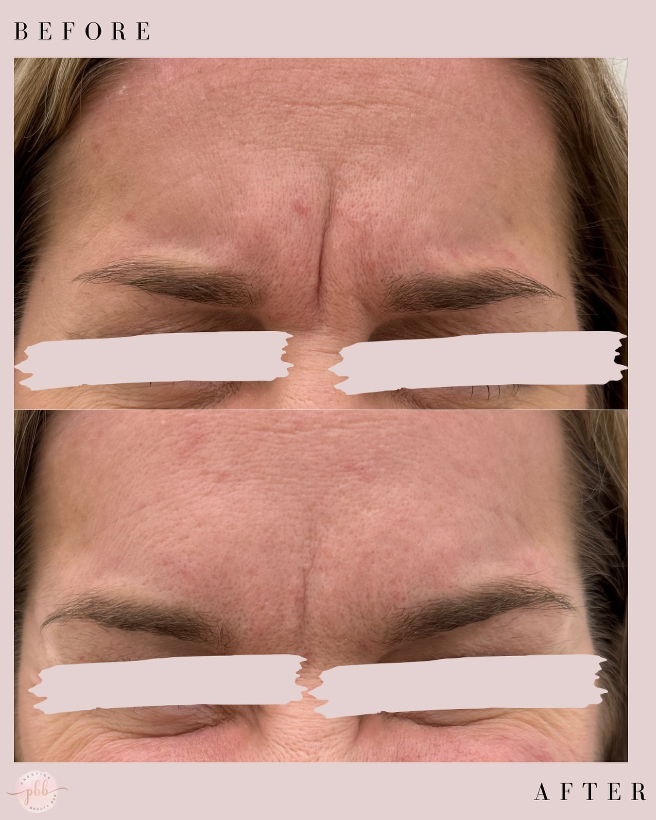 ⨠Neurotoxin 101 āØ
Neurotoxin (like Botox or Dysport) works by relaxing targeted muscles that create expression lines ā think frown lines, forehead lines, and crowās-feet. Over time, repeated movement creases the skin; neurotoxin gives those muscles a ābreak,ā allowing the skin to soften and lines to fade.
ā±ļø Treatment takes about 10ā15 minutes
š§ Results appear gradually over 7ā14 days
ā³ Lasts approximately 3ā4 months
The goal isnāt to freeze your face ā itās to maintain natural expression, just smoother. Preventative. Subtle. Confident.
#Neurotoxin #BotoxEducation #PreventativeAesthetics #SkinScience #AestheticNurse #ConfidenceNotFrozen