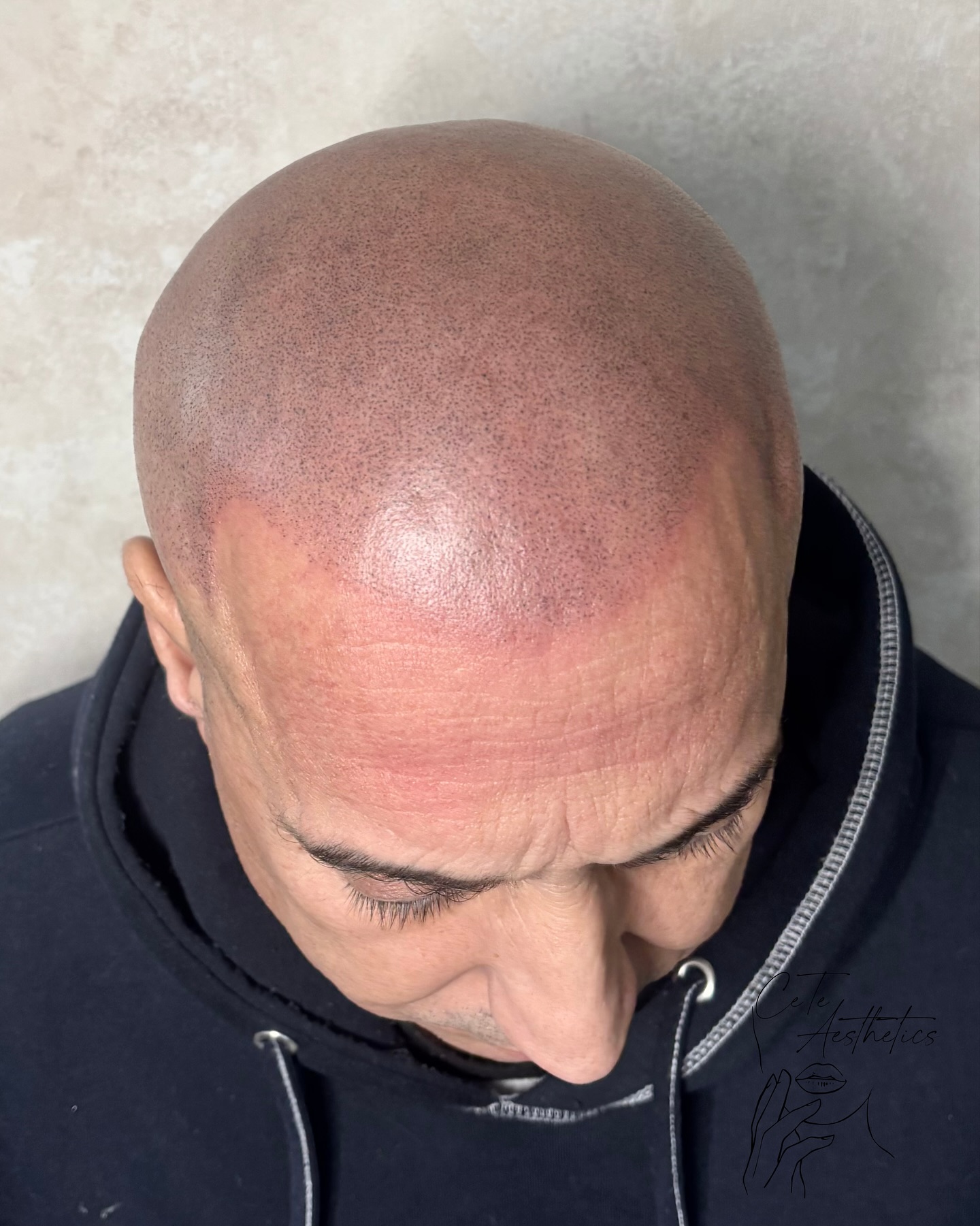 When clients travel for SMP 🤩 a transformation that definitely delivered.
Over 4 sessions, we built a natural-looking hairline that restores shape and density
If you’re looking for SMP in Scunthorpe or North Lincolnshire, CeTe specialises in realistic results that blend perfectly with your natural hair.
Book your scalp micropigmentation consultation online at www.ceteaesthetics.co.uk or send us a DM to get started ✅
-
#SMP #ScalpMicropigmentation #SMPScunthorpe #ScalpMicropigmentationScunthorpe #SMPNorthLincolnshire #ScalpMicropigmentationNorthLincolnshire #SMPUK #HairlineRestoration #SMPResults #SMPForMen #SMPForWomen #HairlineTransformation #CeTeAesthetics #SMPClinic #ConfidenceRestored #ScalpMicropigmentationClinic #HairlineConfidence #NonSurgicalHairLossSolution #ScalpTreatment #micropigmentationuk