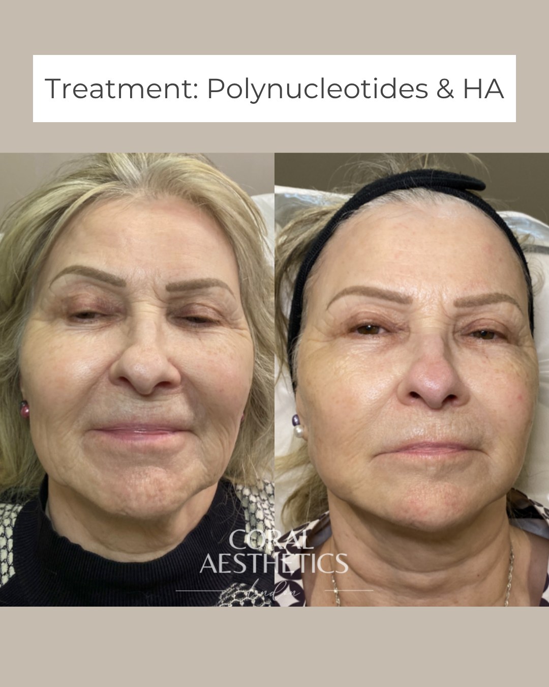 SPOILER ALERT: There’s no single magic wand when it comes to skin!! It’s all about balance.
This client’s glow came from a combined approach: polynucleotides to restore and repair the skin at a cellular level, and hyaluronic acid for deep hydration and structure.
The result?
Healthy, dewy skin. Firmer texture. That fresh, lit-from-within radiance that makeup can’t fake.
When skin is supported from within, it doesn’t just look better - it behaves better.
📍Treatment plan tailored following consultation.
#SkinHealth #Polynucleotides #GlowingSkin #CoralAesthetics #HyaluronicAcid #SkinBoosters