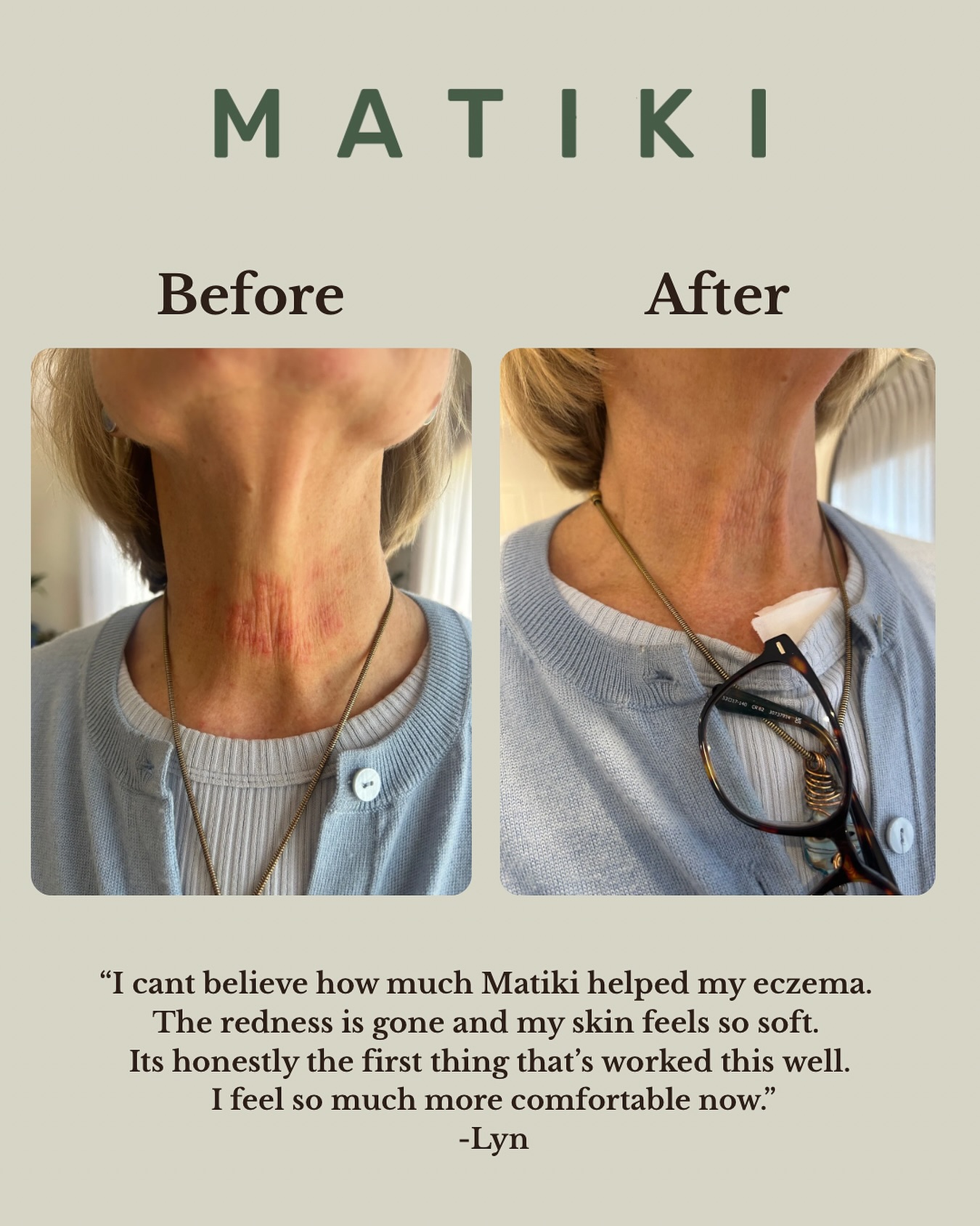 Proof that Matiki really works!
Our customer Lyn saw her eczema clear up within days, literally.
Redness gone. Skin calm. Confidence back.
Try it for yourself, one bottle and youâll be hooked đ¤