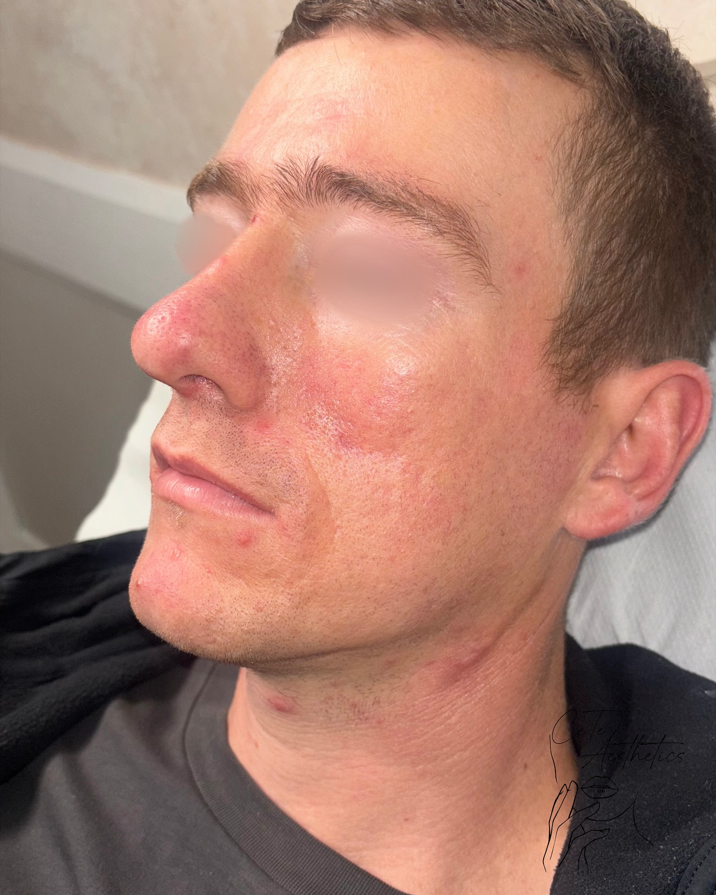 ✨ Real results after just ONE laser skin rejuvenation treatment ✨
This client came to us feeling frustrated with red inflamed skin. After just one session, the difference speaks for itself! Redness has reduced, smoother and noticeably clearer skin.
We chose laser skin rejuvenation because it gently targets redness and boosts your skin’s natural healing process, leaving it looking fresher.
Over the next few treatments, we’ll keep building on these results to:
• Fade redness even further
• Smooth texture and refine pores
Everyone’s skin journey is different, but with consistency, the transformation can be incredible 💫
📍 CeTe Aesthetics, 278 Ashby High Street, Scunthorpe
👩🏽⚕️ Registered Nurse
🌐 www.ceteaesthetics.co.uk
-
#LaserRejuvenation #CeTeAesthetics #MensSkinCare #LaserFacial #HealthySkinJourney #laserhairremoval #laserscunthorpe #maleaesthetics #rosaceatreatment #medicalskincare #fillerscunthorpe #northlincolnshire #scunthorpebusiness #laserskinrejuvenation