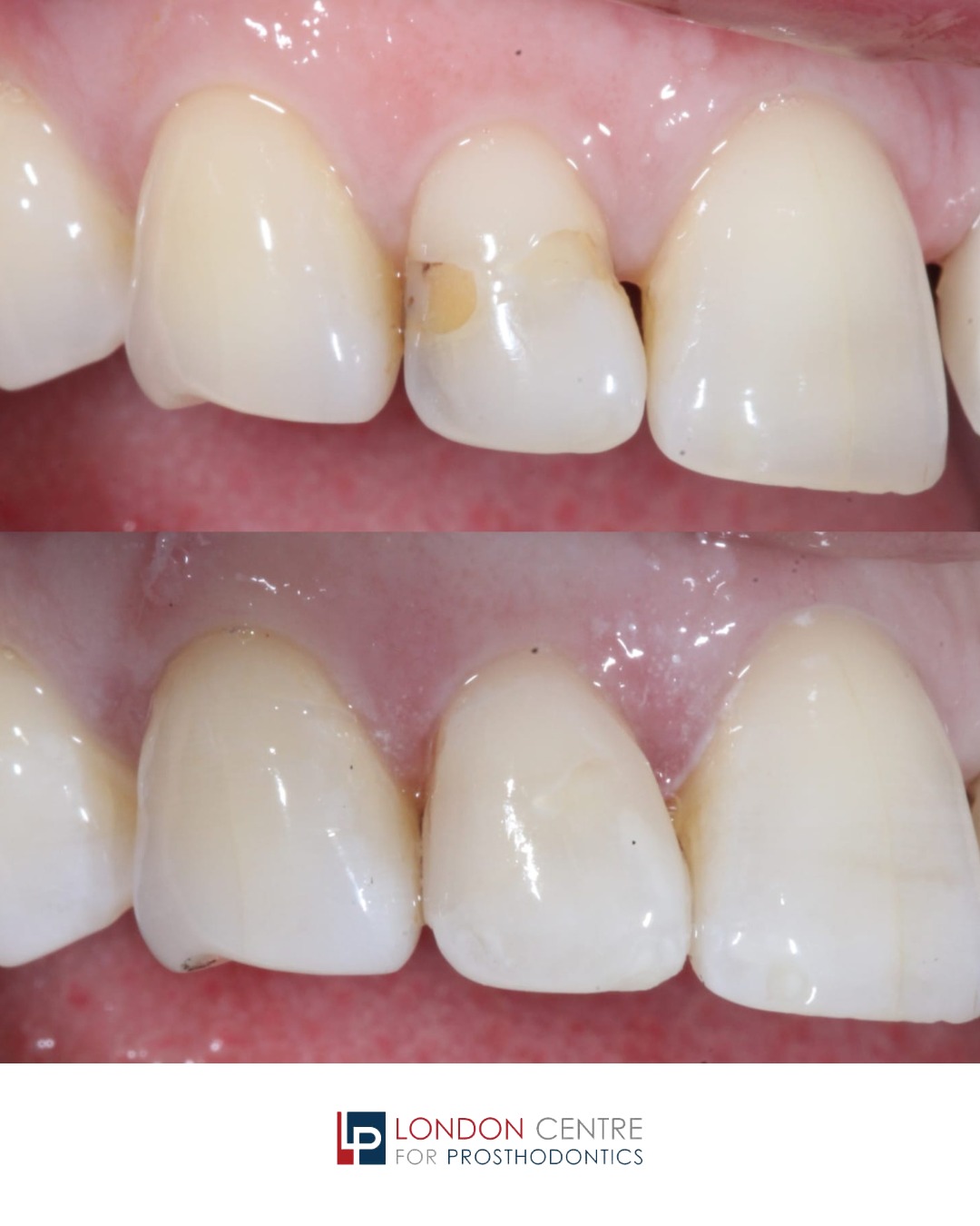 Simple, conservative, elegant and painless treatment! Refresh your smile safely.
Get in touch with our team to book your appointment - we look forward to seeing you soon!
The London Centre For Prosthodontics
29 Weymouth Street
London, W1G 7DB
020 7637 4518
info@londonprosthodontics.com
Monday - Friday: 7:30am - 4:30pm
#MaryleboneDentist #LondonSmiles #HealthyTeethMarylebone #DentalCareLondon #SmileMakeover #MaryleboneOralHealth #LondonDentalExperts #CosmeticDentistry #TeethWhiteningMarylebone #EmergencyDentistLondon #MaryleboneOrthodontics #LondonDentalClinic #DentalCheckup #MaryleboneDentalCare #SmileTransformation
#LondonOralCare #MaryleboneDentalHealth #FamilyDentistLondon #TeethCleaningMarylebone #CosmeticDentistLondon #MaryleboneTeeth #LondonDentalHygiene#MaryleboneOrthodontist #OralWellnessLondon #PreventiveDentistry #MaryleboneDentalServices #LondonDentalSpecialists #MaryleboneHealthySmiles #LondonDentistry #AdvancedDentalCare