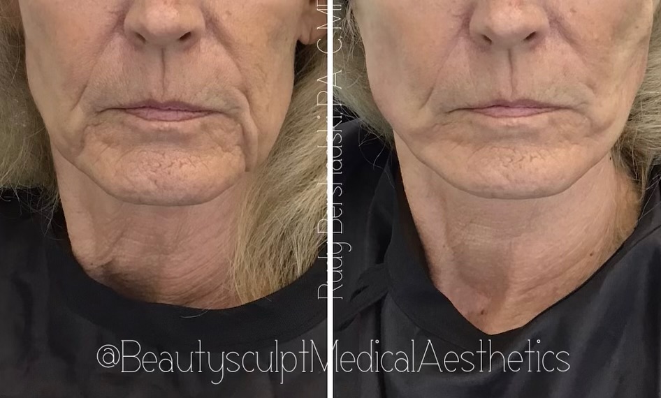PDO (polydioxanone) threads. A natural appearing non-surgical, minimally invasive solution for skin rejuvenation and lifting. Benefits include: Natural collagen stimulation, minimal downtime, reduced lines and wrinkles, long lasting, versatile, safe and customizable. This client requested to remove the wrinkles and laxity around the mouth without changing her appearance… mission accomplished!
Ready for the ultimate rejuvenation experience? 📞 239-777-5002 for a complimentary consultation.
.
.
.
.
.
.
.
.
#medspanaples #PDOThreadsNaples #medicalaestheticsnaples #injectablesnaples #rejuvinatingmedicine #antiaging #healthyskin