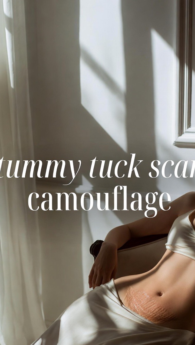 ✨ Tummy Tuck Scar Camouflage — Dark Scar Transformation ✨
You can really see in this video how the hyperpigmentation has softened and how smooth the tummy tuck scar has become. We’ll be adding the final layer of color next to perfectly match the surrounding skin tone — creating a seamless, skin-true finish.
This took time, patience, and advanced medical tattooing techniques to lift the dark pigment, rebuild tone harmony, and restore balance across the abdomen. Whether your scar is from a tummy tuck, mommy makeover, or liposuction, scar camouflage can help you feel confident again in your skin.
At Imagine You New in St. Petersburg, we specialize in realistic results that blend with your natural skin tone — for surgical and post-plastic-surgery scars of all kinds.
And if you’re interested in learning this art, come train at the International Institute of Medical Tattoo Science & Artistry. Our hands-on, small-group classes teach you exactly how to work on real models, correct hyperpigmentation, and match complex tones with precision. You’ll learn how to help others the way we help our clients every day.
📍 St. Petersburg, Florida
🔗 www.imaginenew.com | www.medtattooeducation.com
#tummytuck #mommymakeover #medicaltattooing #scarcamouflage #tummytuckscar #scarcamouflagetattoo #liposuction #plasticsurgery #stpetersburg #tampa #sarasota #orlando #florida #paramedicaltattoo #paramedicaltattooartist #scarremoval #scarrevision #stpete #imaginenew #medtattooeducation #3Dareolatattoo #stretchmarkcamouflage #scartraining #paramedicaltattootraining