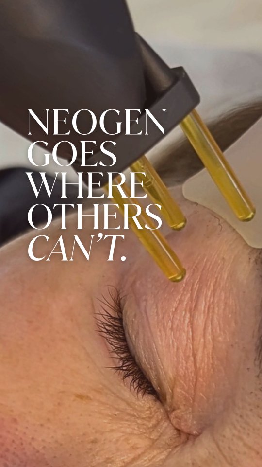 NeoGen is one of the few treatments gentle enough to rejuvenate the entire eyelid area, right up to the lash line!
No needles, no downtime, just smoother, tighter, more youthful-looking eyes 👁✨️
Eye rejuvenation, redefined.
Book your FREE consultation TODAY!
@neogenplasma_official
#eyetreatment #neogen #eyerejuventation #neogenplasma #noneedles #rejuvenate #tightening #freshskin #renew #nitrogenplasma #youthful #feelgood #isleofwight #iow #aestheticclinicsoutheast