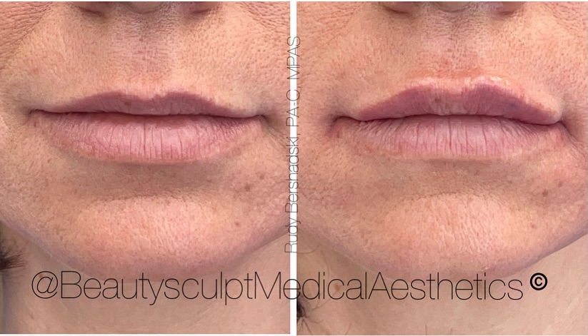 Natural lip rejuvenation!
Hyaluronic acid (HA) lip filler injections are used for volume repletion, hydration, shape and definition. This allows for a minimally invasive and instant rejuvenated, natural look and feel.
📞 239-777-5002 for a complimentary consultation.
.
.
.
.
#lipinjectionsnaples #aestheticsnaples #medspanaples #medicalaestheticsnaples #injectablesnaples #naplesflorida
