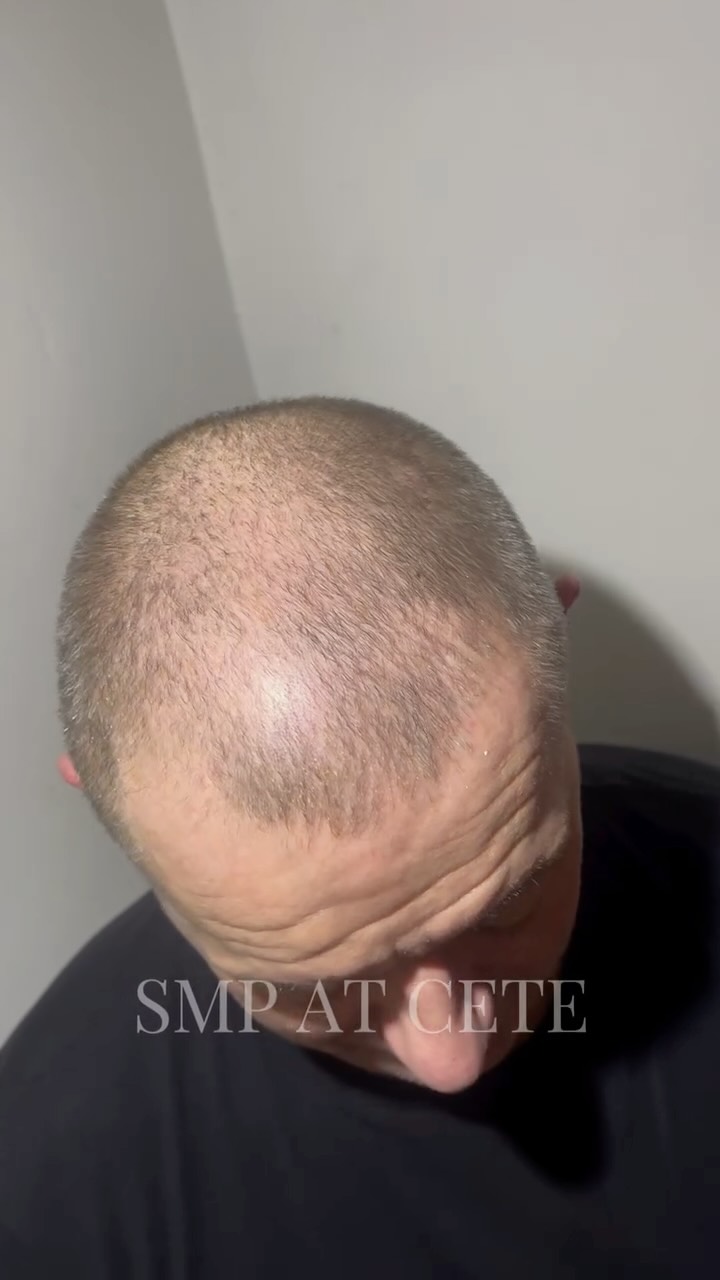 CHOOSE SMP 🔥
Tired of hiding thinning areas or bald spots every morning? It’s time for a permanent fix.
✅ SMP delivers 100% guaranteed results – no waiting, no guessing, just instant confidence.
✅ No more wasting time styling or covering up – wake up looking sharp every day.
Take control of your look today 👊
📲 Book your consultation now at www.ceteaesthetics.co.uk or send us a DM to get started!
#smplincolnshire #hairloss #scalpmicropigmentation #smpscunthorpe #hairtattoo #smpuk