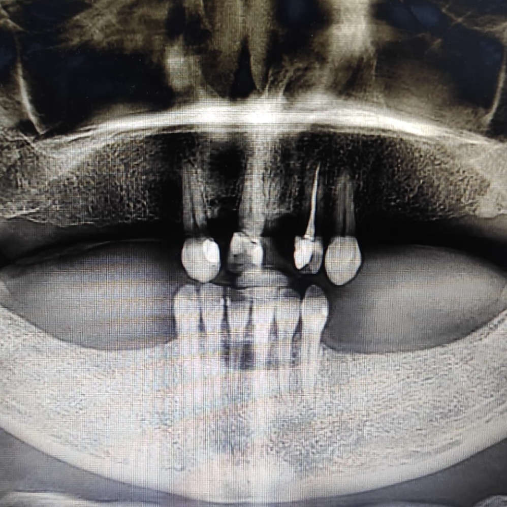 Dentes Fixos no dia.
Veja como o Dr. Helder Lopes transformou este sorriso.
O Poder da Estética e Função.