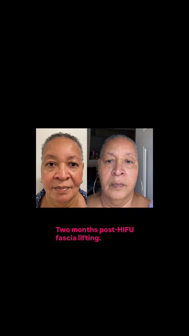 Two months post-HIFU fascia lifting: noticeable eye rejuvenation, improved facial lift, refined nasolabial folds, and a youthful, radiant appearance.
✅✅✅✅✅✅✅✅✅✅✅✅✅✅
#capricebeautybar #age #sarasotaflorida #skin #sarasota #hifu #sarasotaskincare #sarasotalasertreatment #sarasotapeels #sarasota_fl #sarasotamedspas #siestakeyspa #nyc