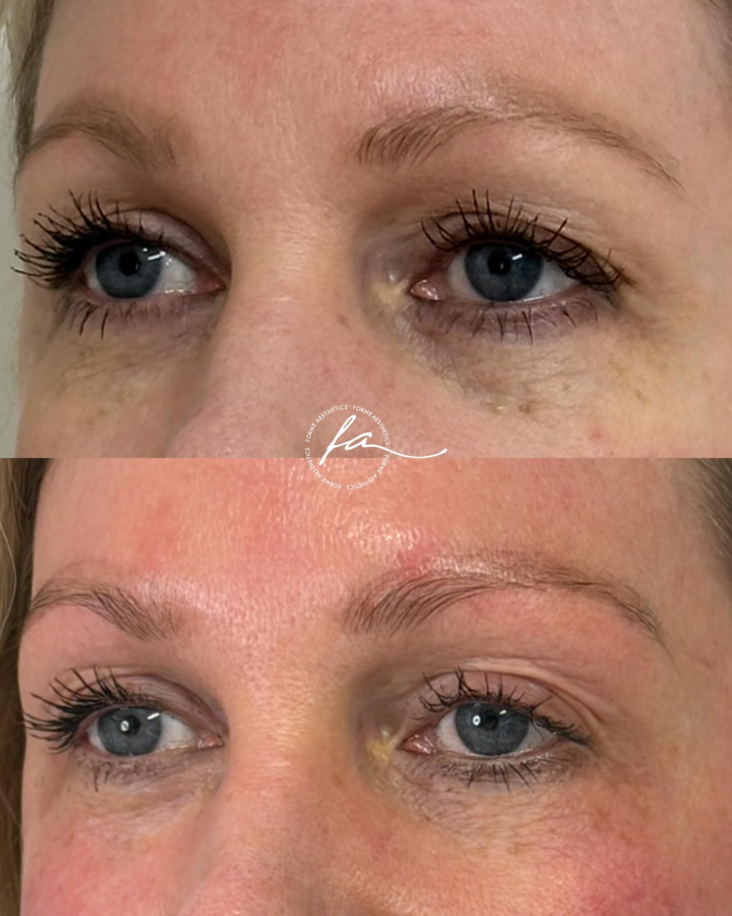 Before and 6 weeks after 1 Tixel session
Crepey or lax skin around the eyes is something a lot of people notice first, mostly because the eyelid skin is naturally thin and shows changes earlier than other areas.
Tixel uses a small heated plate that briefly and precisely touches the skin. This controlled thermal contact creates tiny micro-injuries that signal the skin to repair. Through this healing process, collagen and elastin gradually increase. Over time, suitable candidates may notice an improvement in texture, firmness and the appearance of crepiness.
Most people complete a series of three sessions spaced four to six weeks apart. Some may choose additional treatments depending on their individual concerns. Downtime is usually mild. Redness, dryness and tiny grid marks can appear for a few days.
This example reflects only one person’s experience. Outcomes vary from individual to individual based on skin type, concerns and overall treatment planning.
Important information
All skin treatments carry potential risks, such as irritation, swelling, pigment changes, prolonged redness. A full consultation is essential to assess your medical history, confirm suitability and talk through possible risks and expected recovery.
If you are noticing changes around your eyes and want to explore options that support texture and firmness, a consultation allows me to assess your skin properly and discuss what may be appropriate for you.