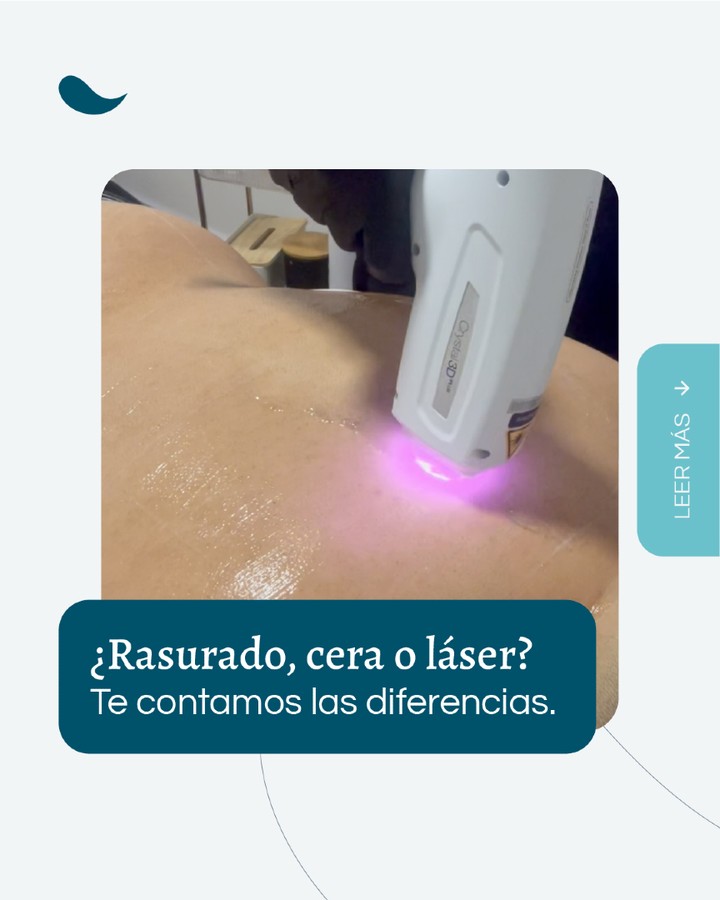 ¿Rasurado, cera o láser? Te contamos las diferencias para que elijas lo mejor para tu piel.
✨ Rasurado: rápido y práctico, pero puede irritar y el vello vuelve al día siguiente.
🔥 Cera: dura más, pero es dolorosa y puede inflamar o sensibilizar la piel con el tiempo.
💡 Láser: prácticamente indoloro, de larga duración, mejora la textura y previene la foliculitis.
Reservá tu sesión y despedite de los métodos temporales 💙