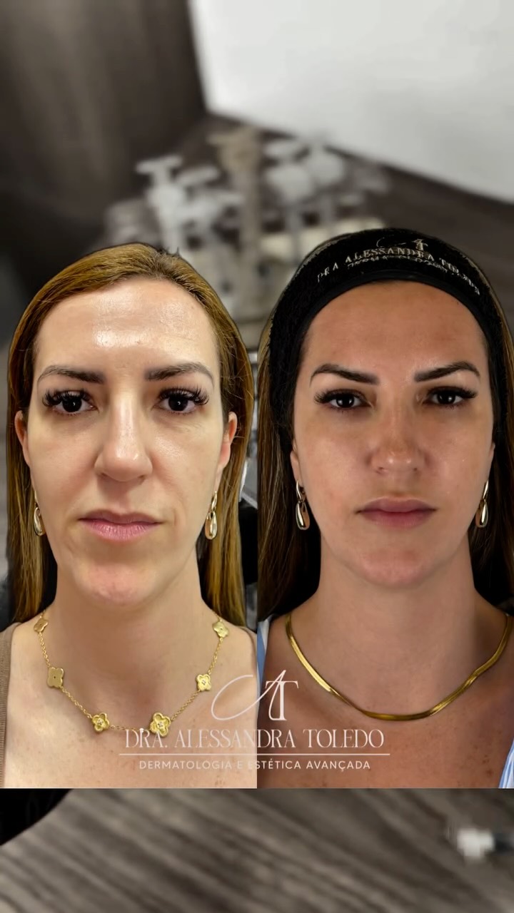 Eu não trabalho com quantidade de mls.
Trabalho com resultados reais, harmônicos e duradouros.
Cada rosto é único, e o protocolo Face Up também.
✨ Um método exclusivo, criado para realçar sua beleza natural com equilíbrio e técnica.
Se você busca um resultado que valorize sua essência e não apague quem você é, agende sua avaliação e descubra o poder do seu Face Up personalizado. 💎
#FaceUp #HarmonizacaoFacialNatural #ResultadosReais #DraAlessandraToledo