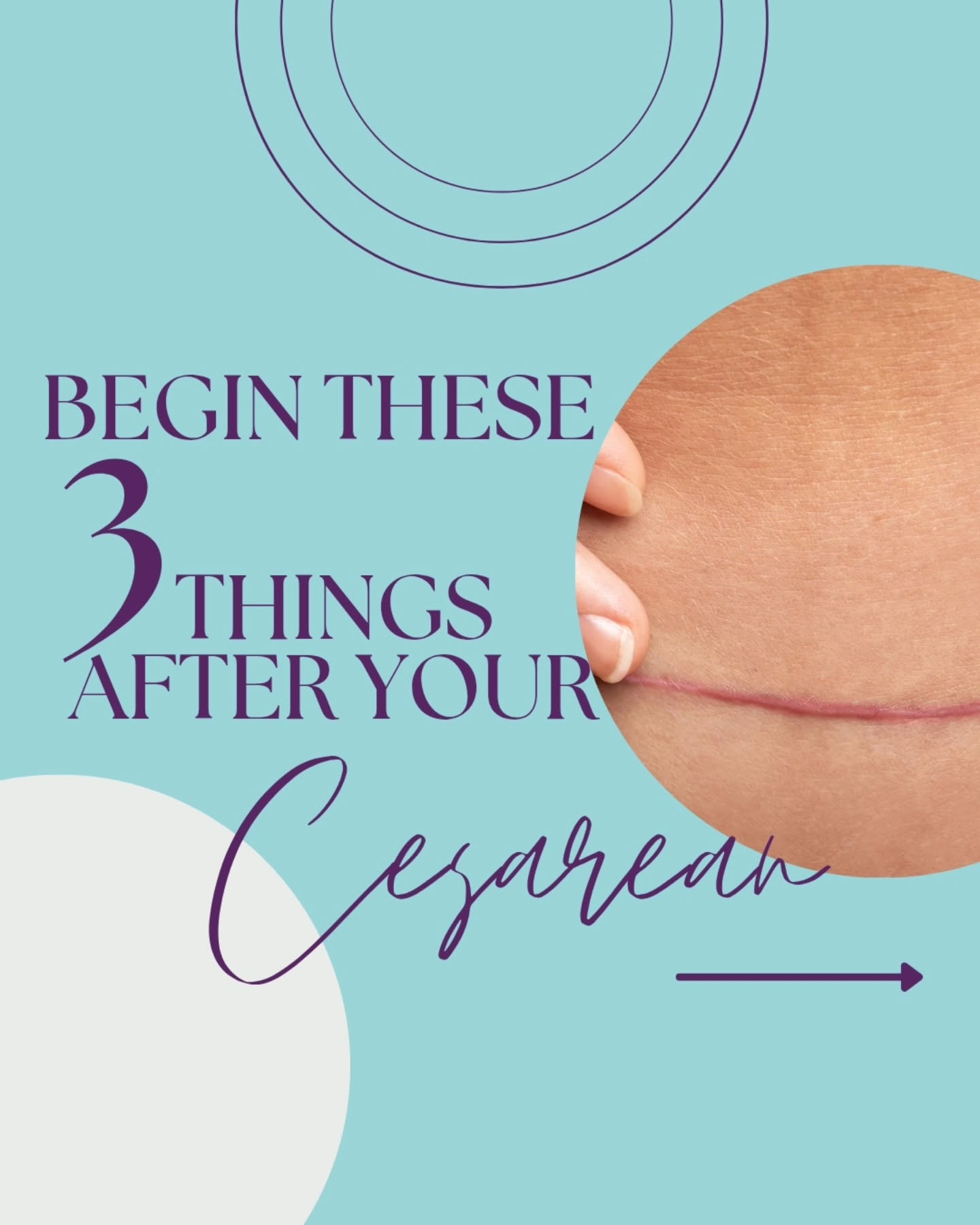 Caring for your scar can feel really overwhelming so comment VIDEO for a free tutorial on scar desensitization to help you begin to know where to start.
Because contrary to what your doctor told you, there are things you can do to help aid in your recovery after a cesarean.
In fact, I think I highly encourage them just to help you feel better not just now, but long term as well.
Because what your doctor isn't explaining to you is that your scar can really disrupt your deep core system causing you to have difficulty breathing to your pelvic floor, engaging your core, and getting the two to connect.
This disruption can be a big root cause of
❌️ low back pain
❌️ pain with intercouse
❌️ a diastasis that never heals
❌️ even prolapse
This happens because your scar will have adhesion build up if this isn't broken down. And adhesions act like sticky tack in the body holding everything in place and pulling in towards the scar instead of allowing the tissues to move and glide.
So getting the body diaphragmatically breathing, lengthening the tissues around the scar and beginning to desensitize your scar all help with minimizing adhesion growth.
Couple that with exercises for early postpartum and you can not only help your scar, but help you feel more connected through your body.
If you're needing that, I encourage you to look into my early postpartum program - Resilient Recovery. Comment RECOVERY for a link to join.
Be Resilient Mama!
#cesareanrecovery #cesareanbirth #cesareanmama #csectionrecovery #csection #csectionmom #csectionbaby #scarhealing #adhesions #postpartumfitnessjourney #postpartumfitness #4thtrimester #4thtrimesterbody #ppacocoach #resilientmamafitness