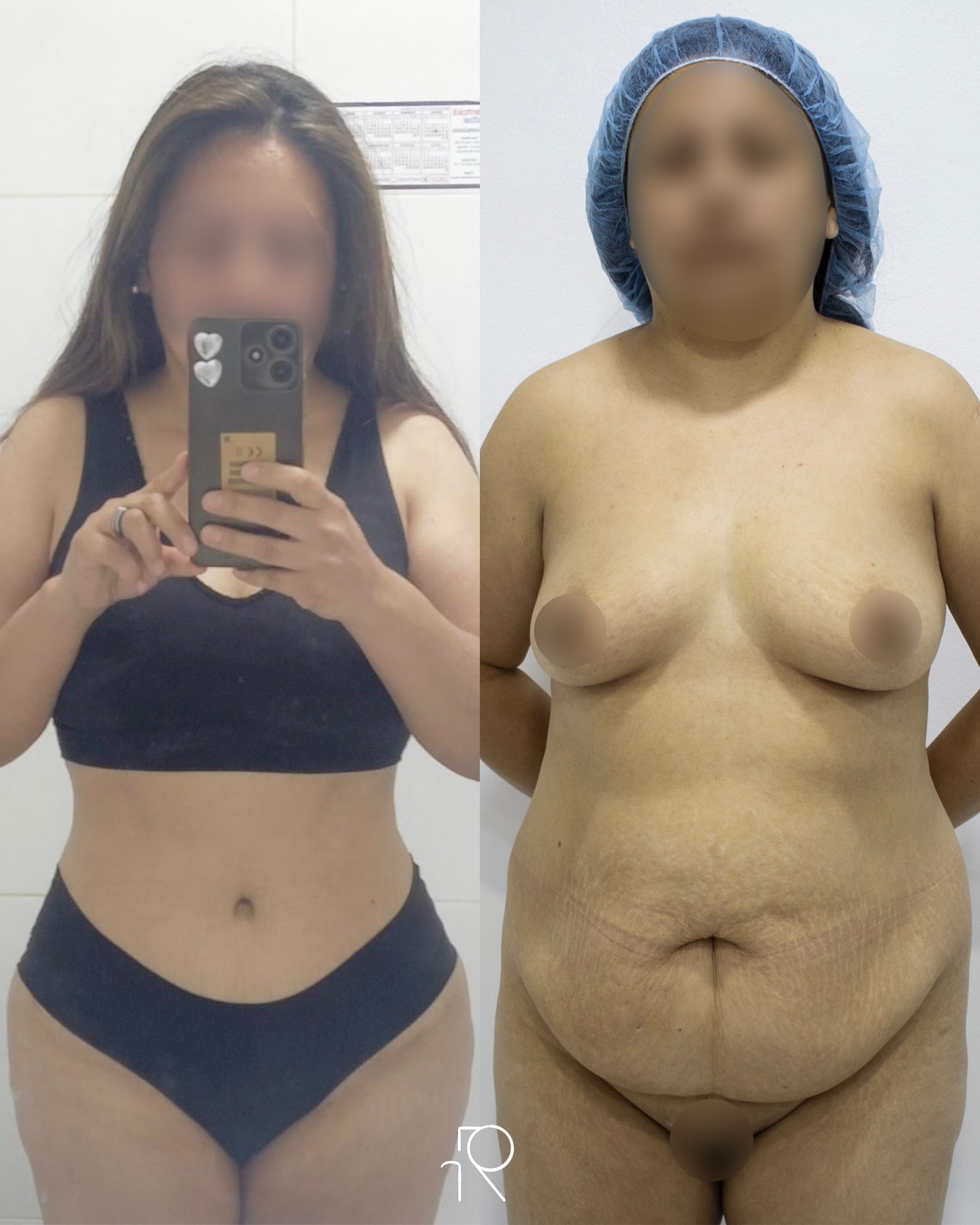 Agradezco a mi querida paciente por enviarme esta foto que no solo me permite compartir su resultado, sino también mostrar una evolución llena de compromiso, dedicación y amor 🩵Así se ve una abdominoplastia 4 años después