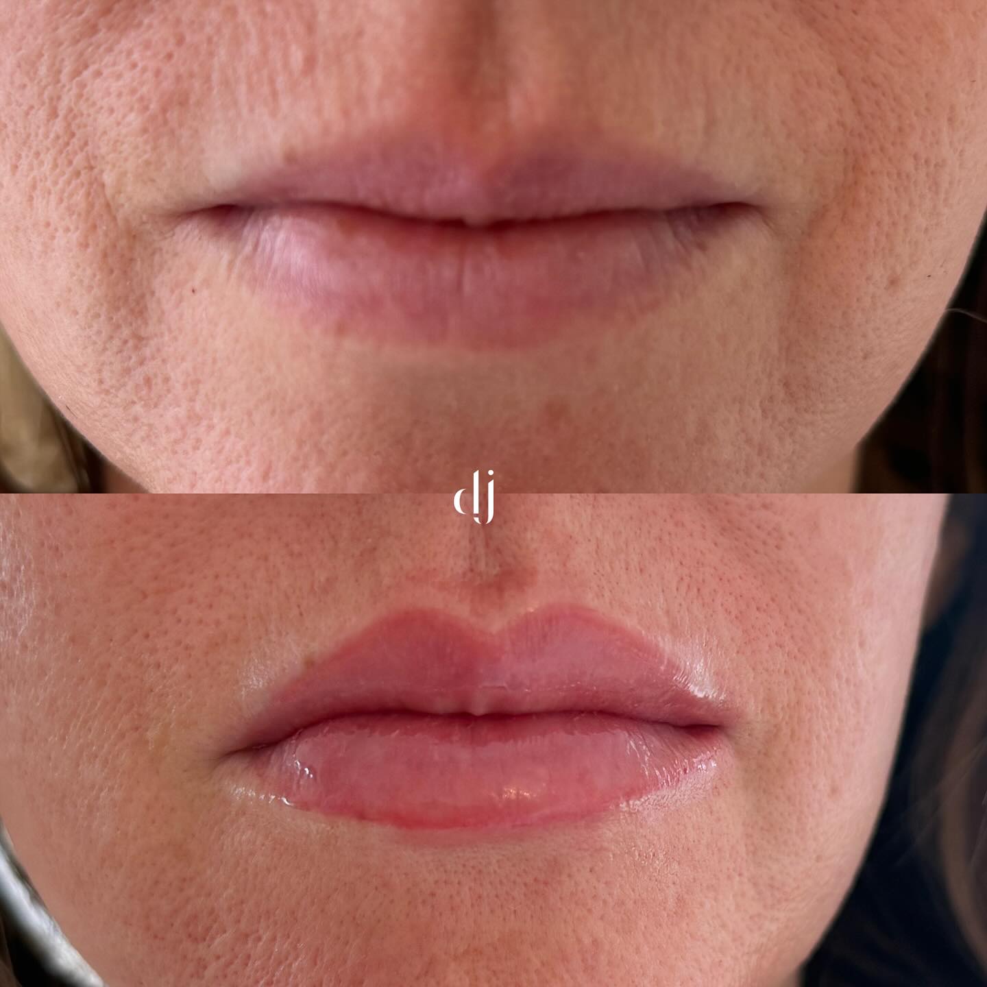 Subtle lip blush results
Lovely & soft for a natural look
We love natural looks 💋❤️
#lipblushtattoo #lipblushtattoo #pmu #semipermanentmakeup