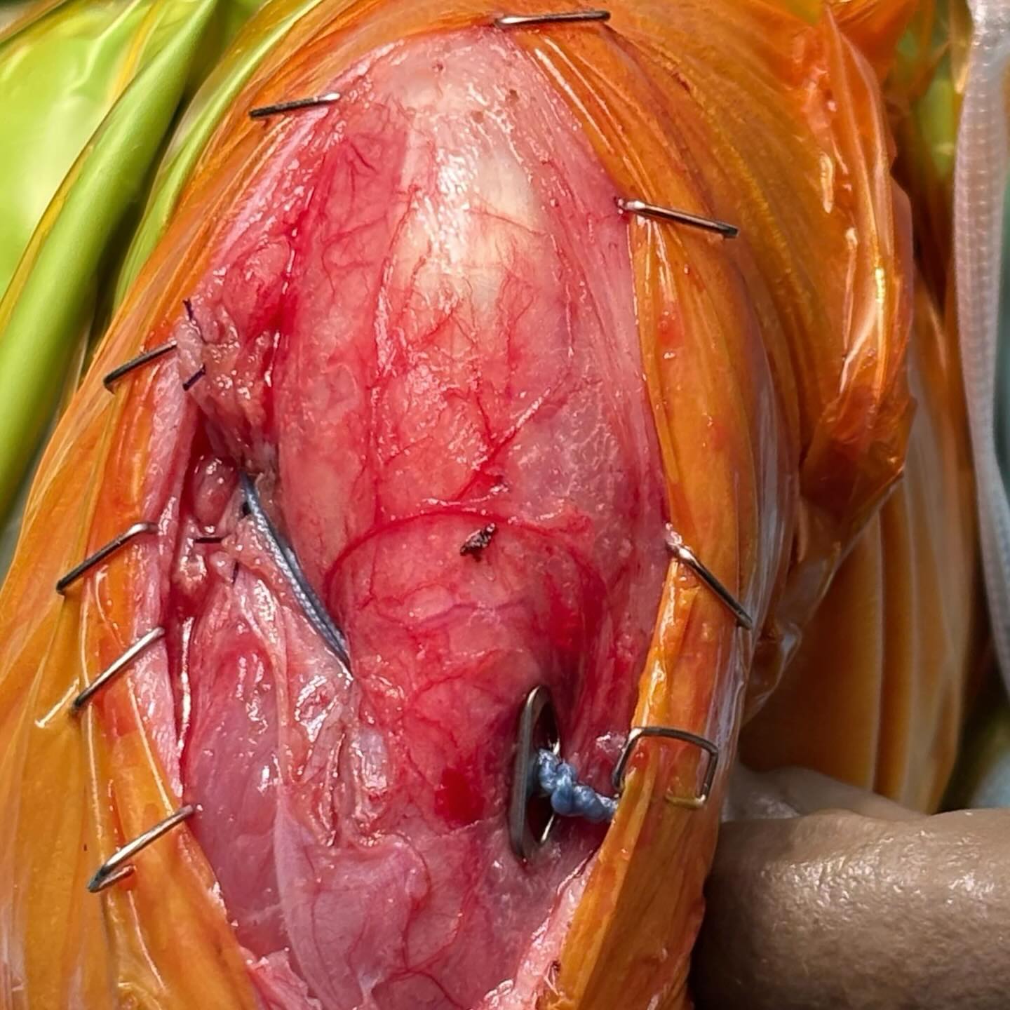 Extra-articular stabilisation in a 5 year 6 mo MN Balinese for complete cruciate rupture using a No. 2 metric FiberWire with toggle button placed on the medial aspect of the tibia. Video is a couple of hours after surgery